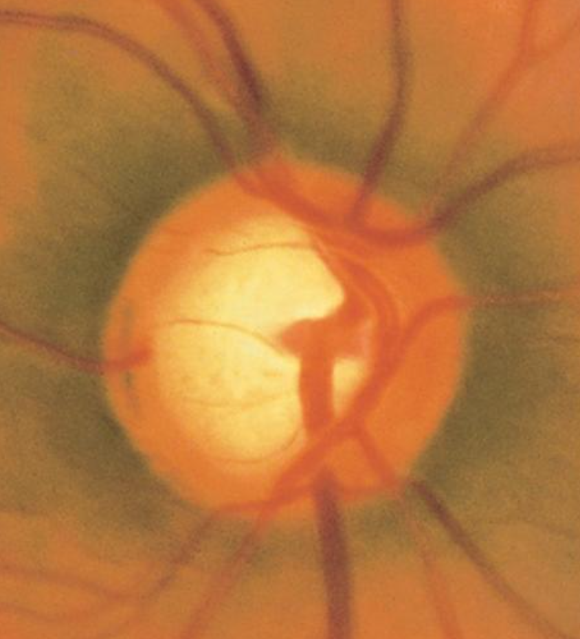 <p>Optic Nerve Cup-to-Disc Ratio of 0