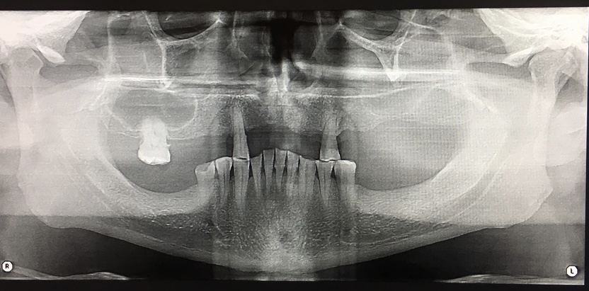 Panoramic radiograph shows right and left maxillary sinuses.