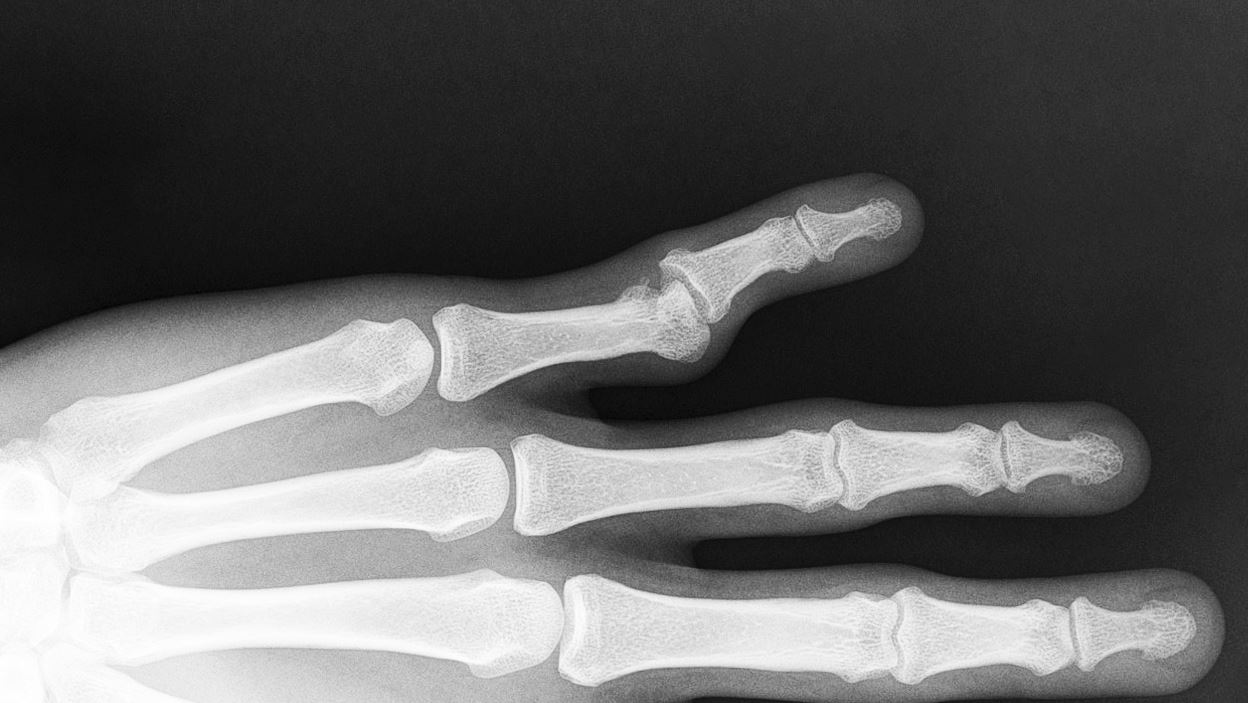 <p>Radiograph of a Left&nbsp;Proximal Interphalangeal Dislocation</p>