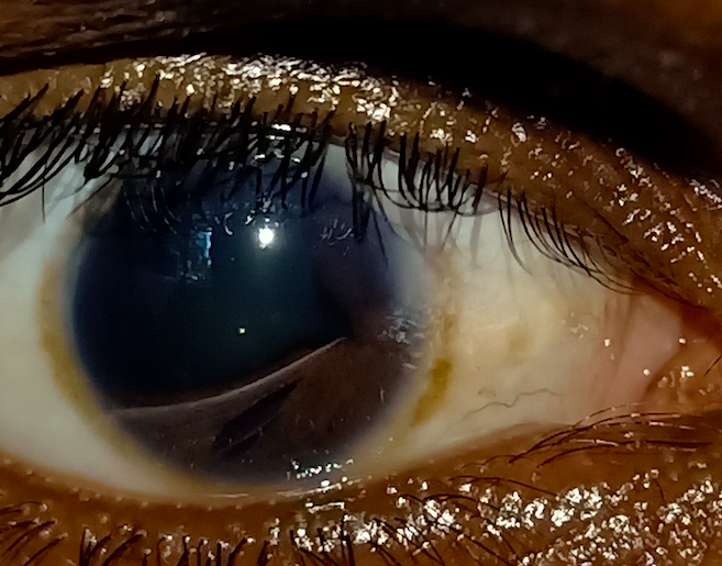 The slit lamp image of the patient depicts posterior embryotoxon, moderate anterior chamber depth, correctopia, polycoria, early iris atrophy, and iris mammillations