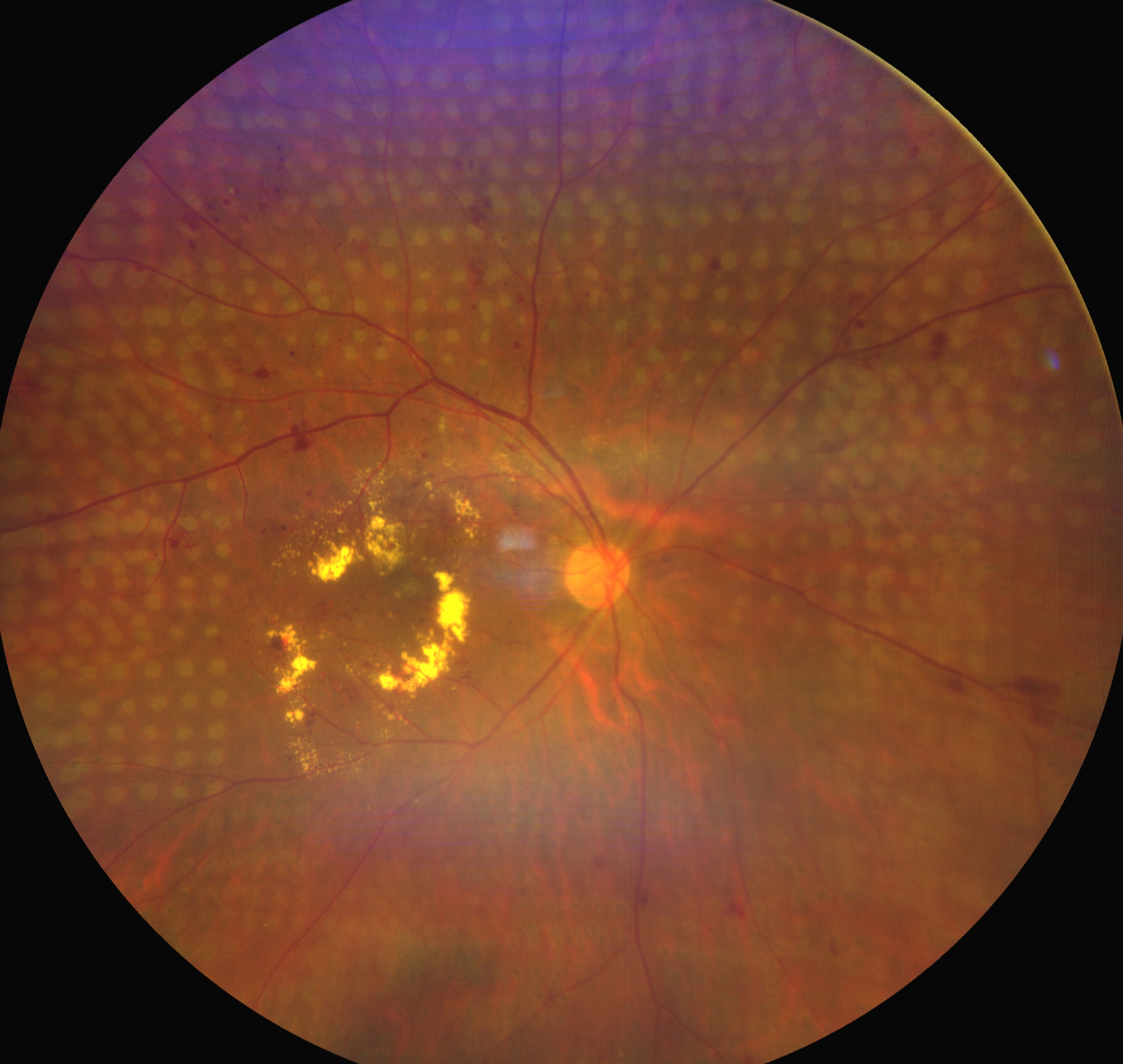<p>Regressed Neovascularization of the Disc and Neovascularization Elsewhere in an Eye With Proliferative Diabetic Retinopathy