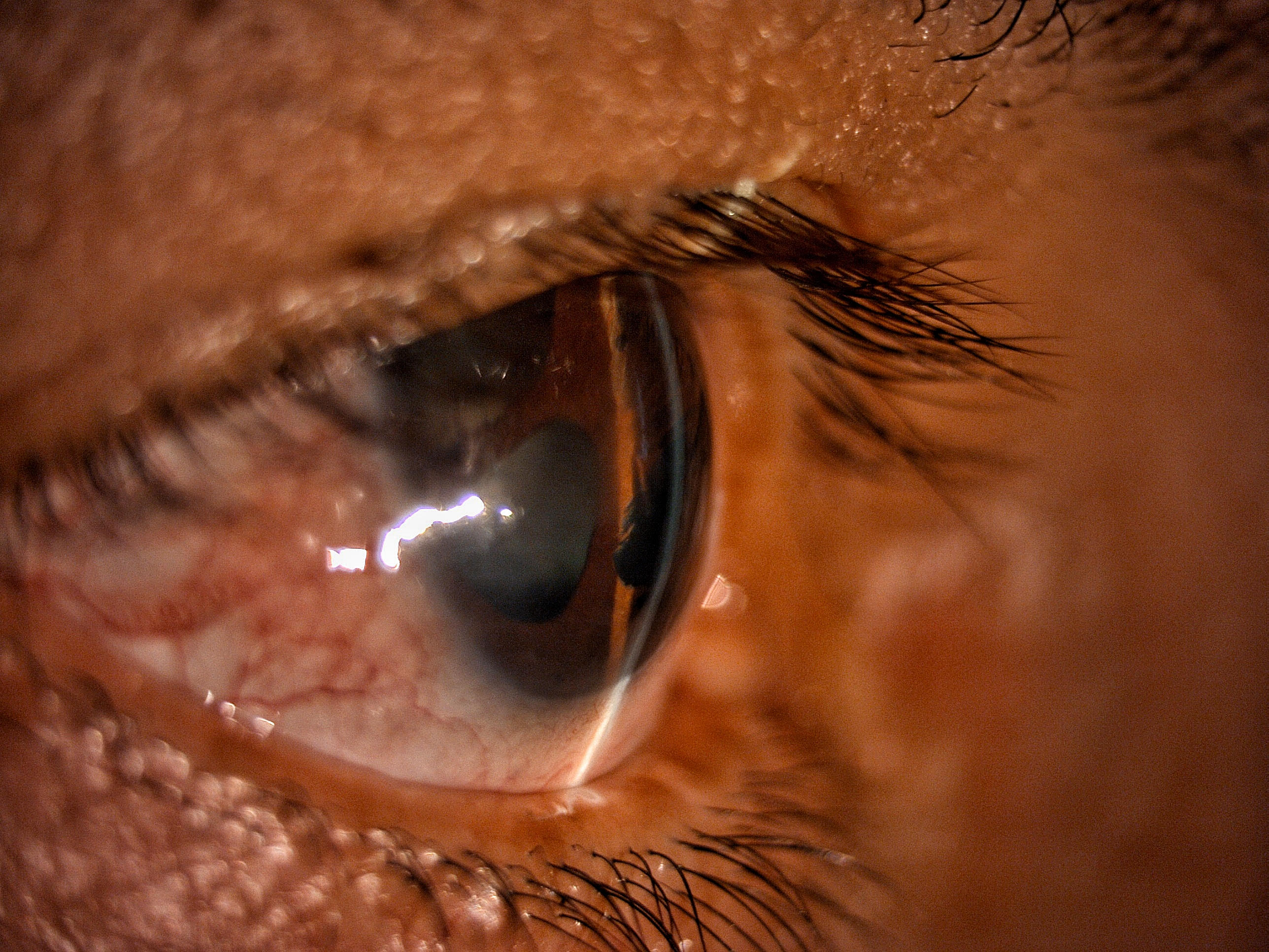 Iridocorneal Endothelial Syndrome: Secondary Angle-Closure Glaucoma