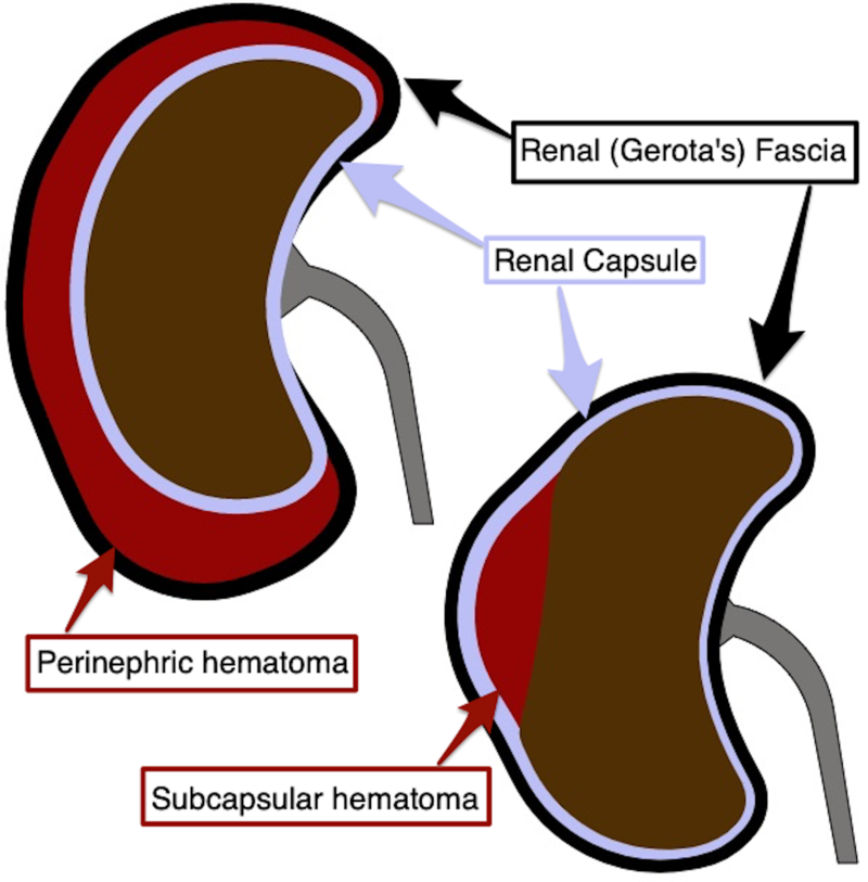 Examples of renal hematoma with relevant anatomy.