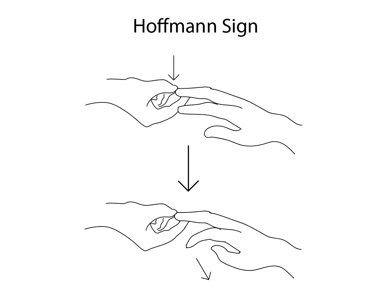 <p>Hoffmann Sign. Diagram depicting a positive Hoffmann sign.</p>