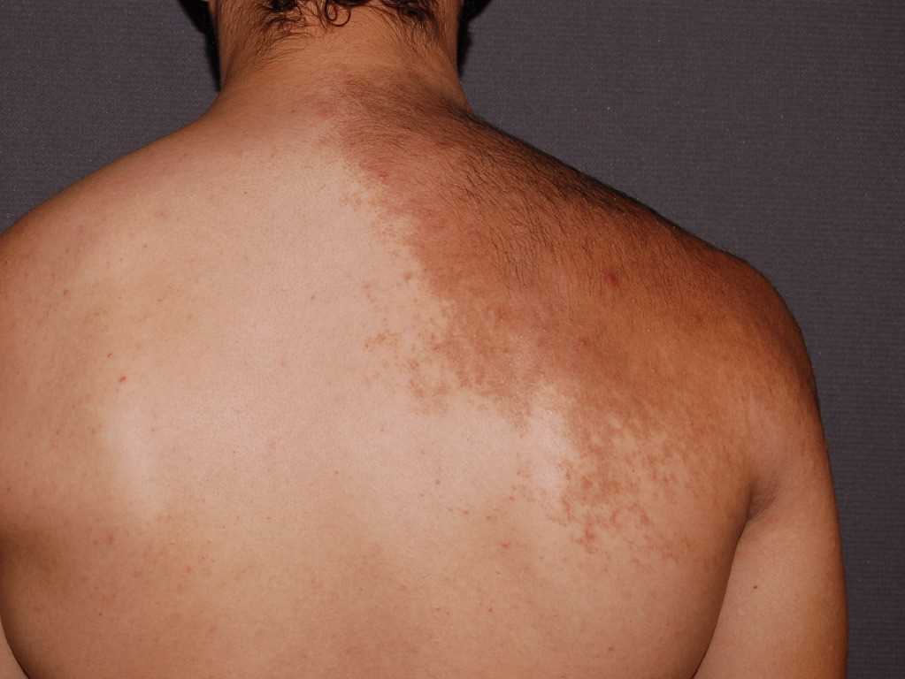 <p>Becker Melanosis. Becker melanosis (Becker nevus) is a form of acquired hyperpigmentation.</p>