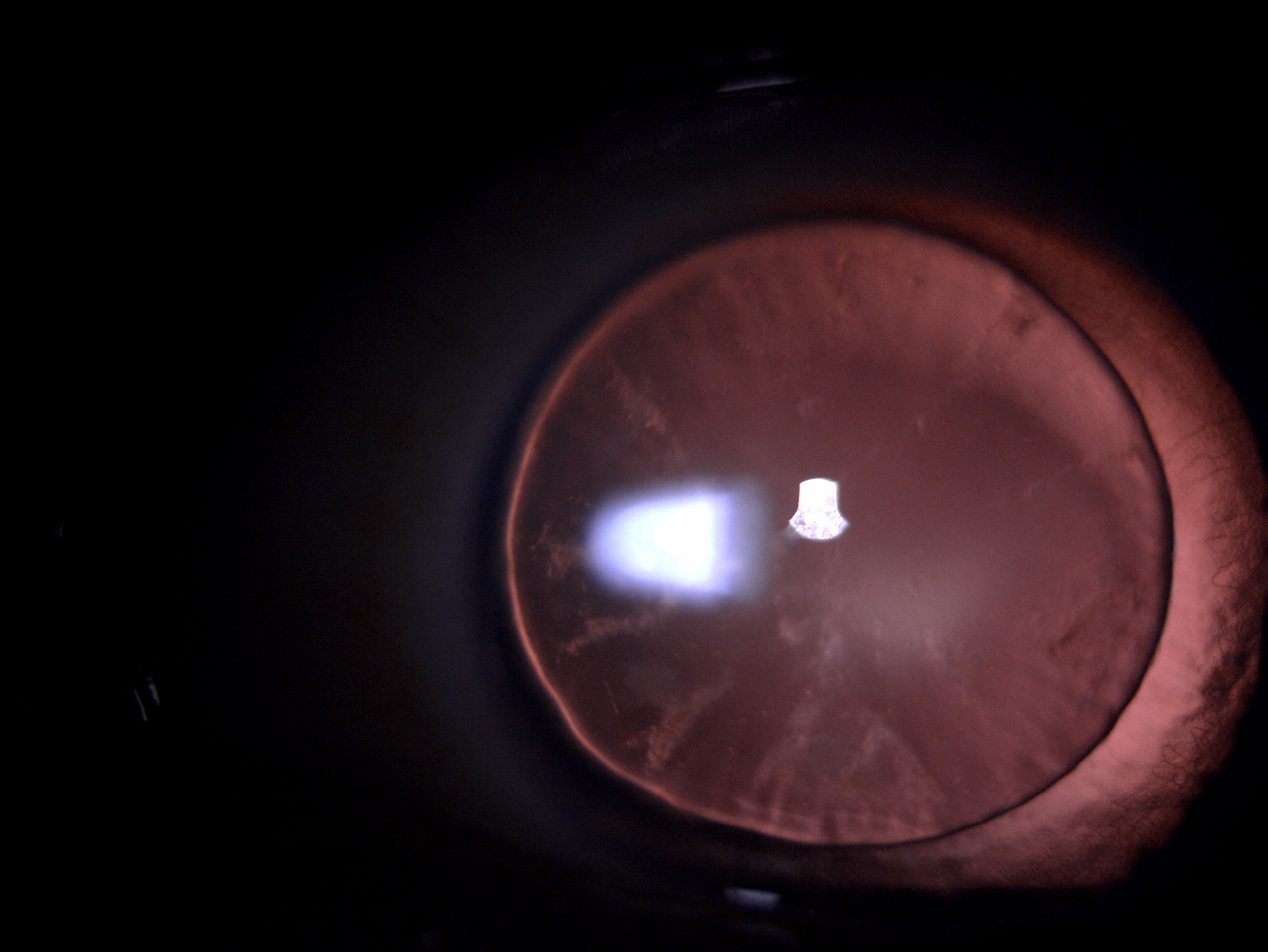 Retro-illumination slit lamp image of the patient depicting small diameter microspherophakic lens with an equator of lens vis