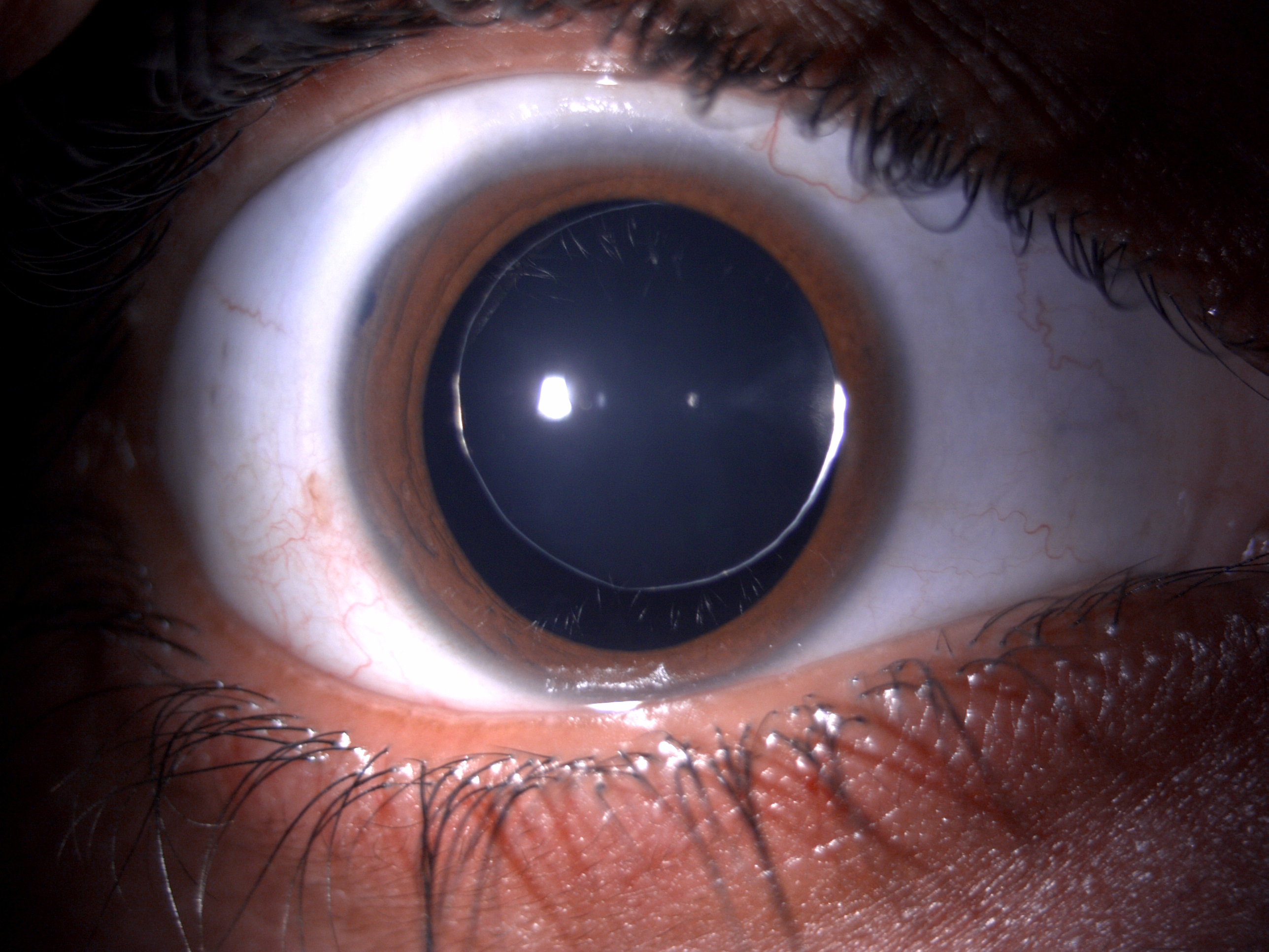 Digital slit lamp image of the patient depicting small microspherophakic clear lens with equator of lens visible under full m