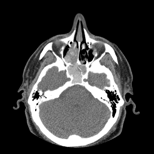 <p>Axial View Fungal Sinusitis</p>