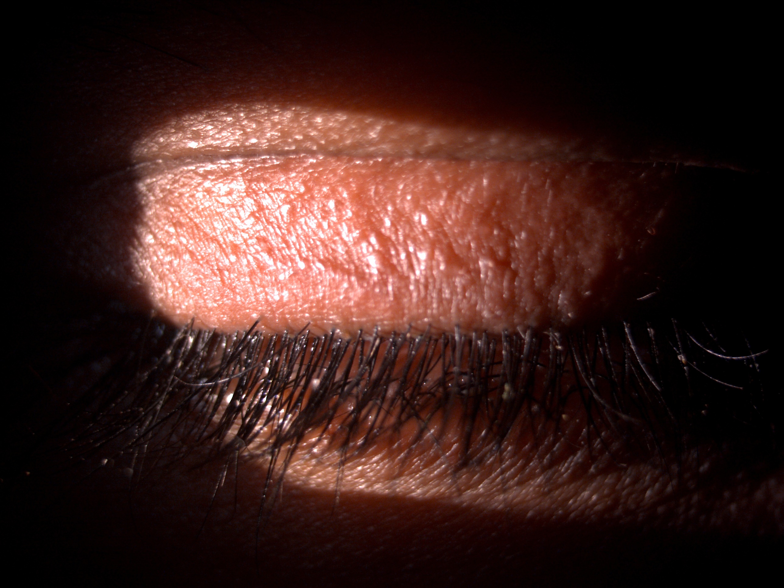 Slit lamp image of the patient's eyelashes depicting seborrheic anterior blepharitis secondary to Phthiriasis palpebrarum