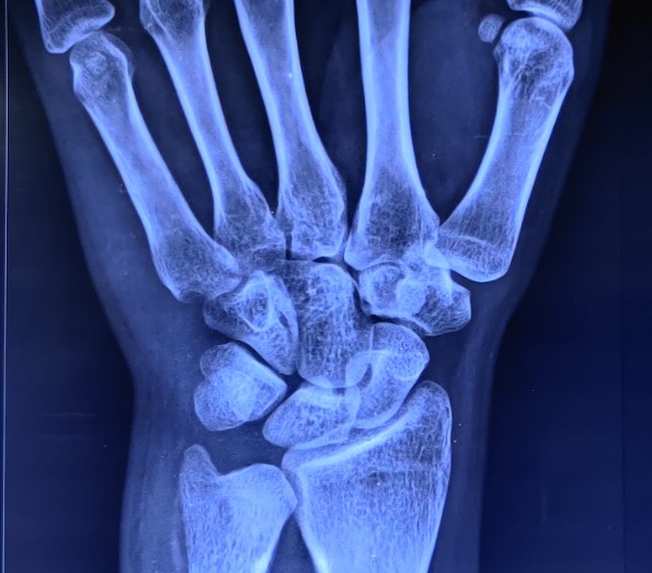 Normal posteroanterior radiograph of wrist joint showing the normal alignment of the carpal bones