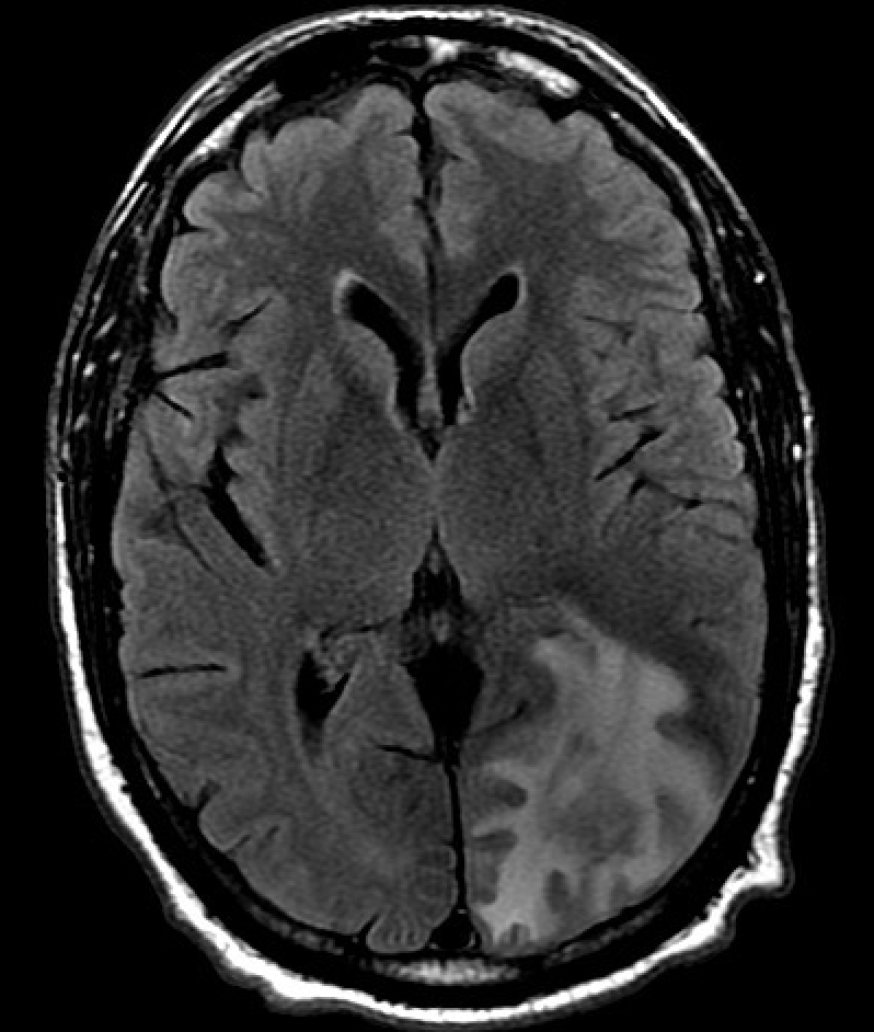 <p>Posterior Reversible Encephalopathy Syndrome on Magnetic Resonance Imaging</p>