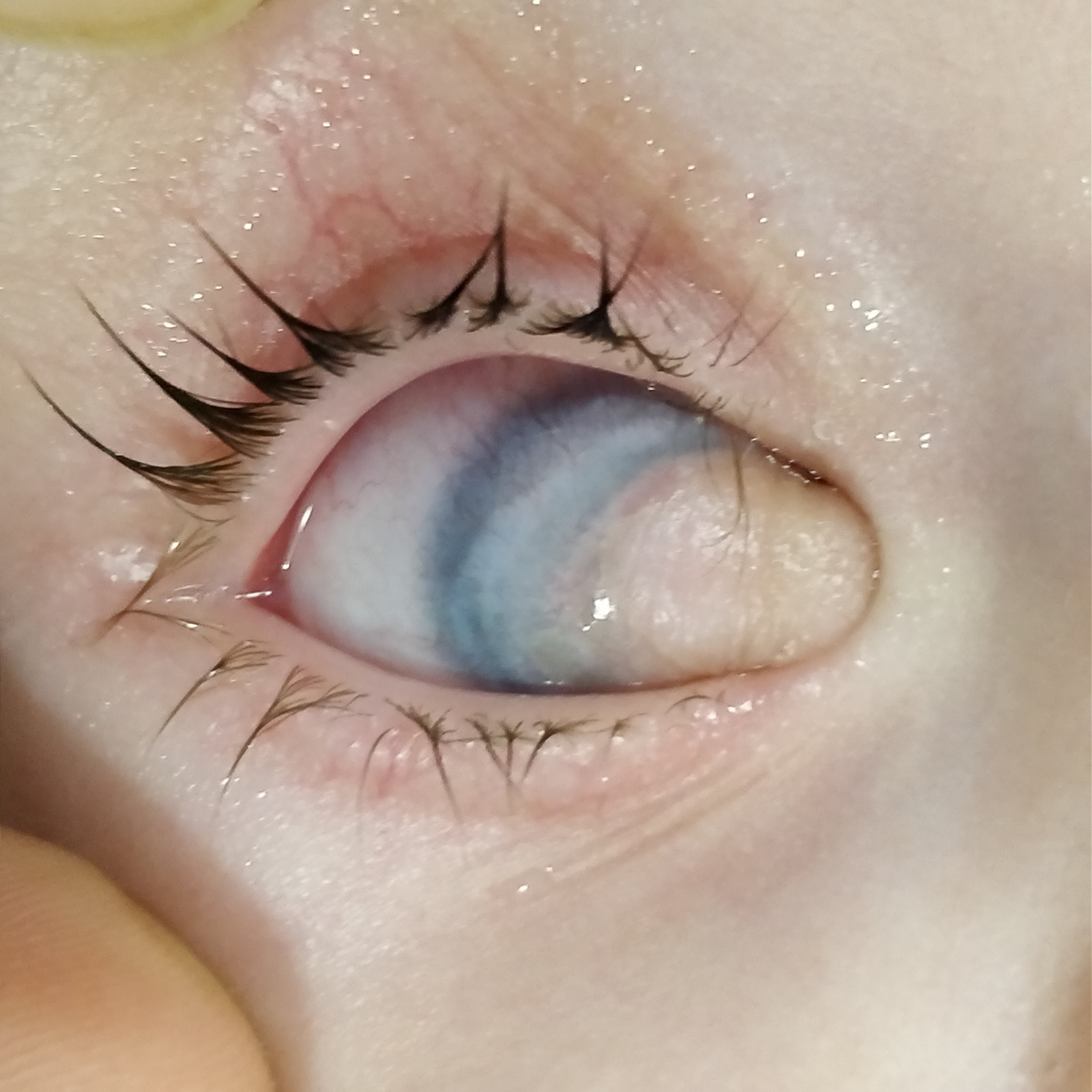 Clinical Photograph of a  18 months old patient with limbal dermoid in right eye.