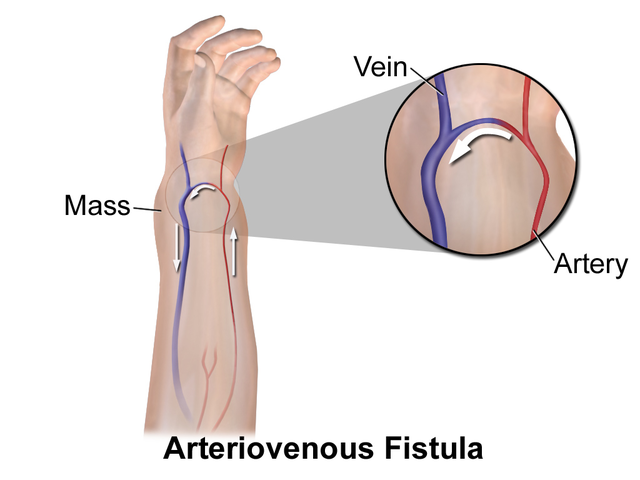 <p>Diagram of Arteriovenous Fistula</p>