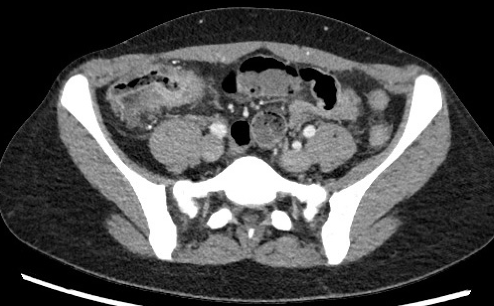 <p>Crohn Disease on Computed Tomography.</p>