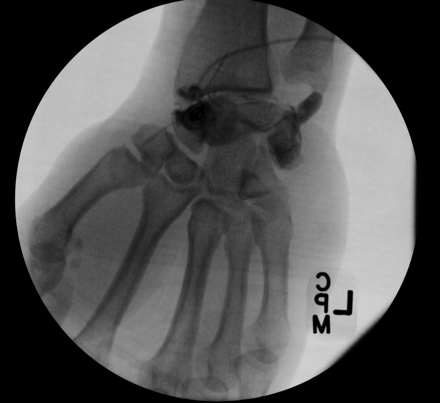 <p>Wrist Arthrogram