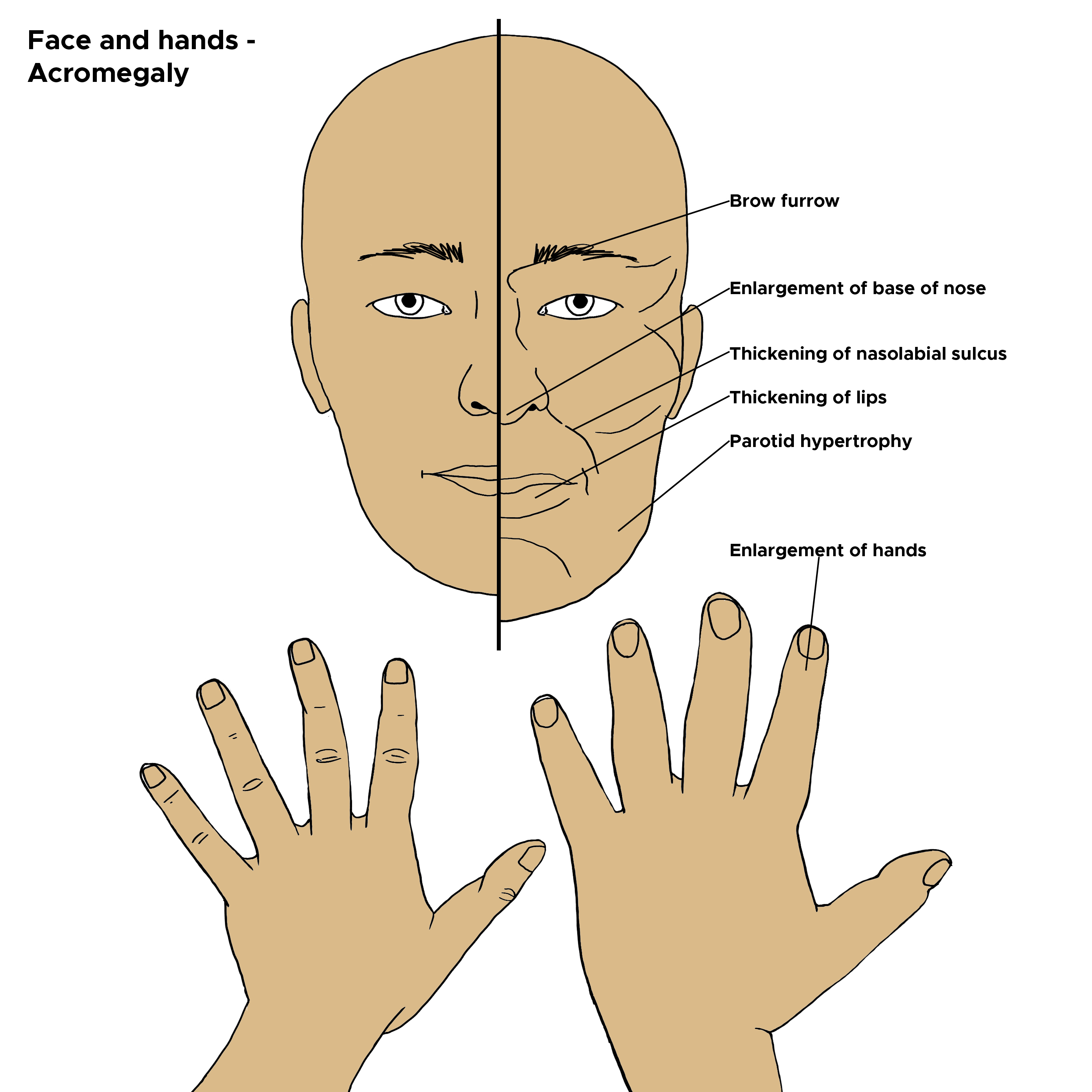 <p>Acromegaly, gigantism. Illustrated image of physical attributes of&nbsp;acromegaly of the face and hands.&nbsp;</p>