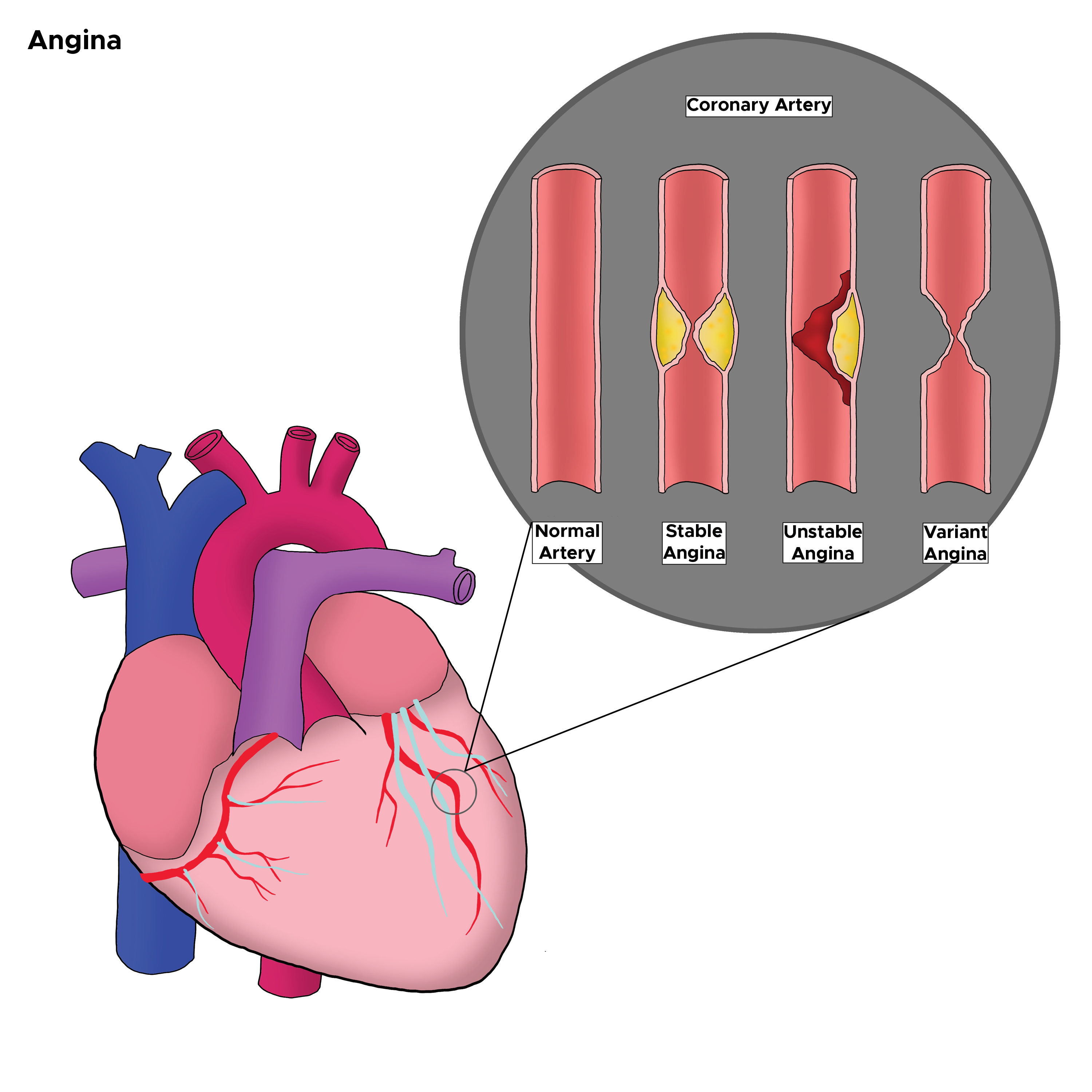 <p>Types of Angina in the Coronary Artery. The illustration depicts stable angina, unstable angina, and variant angina.</p>