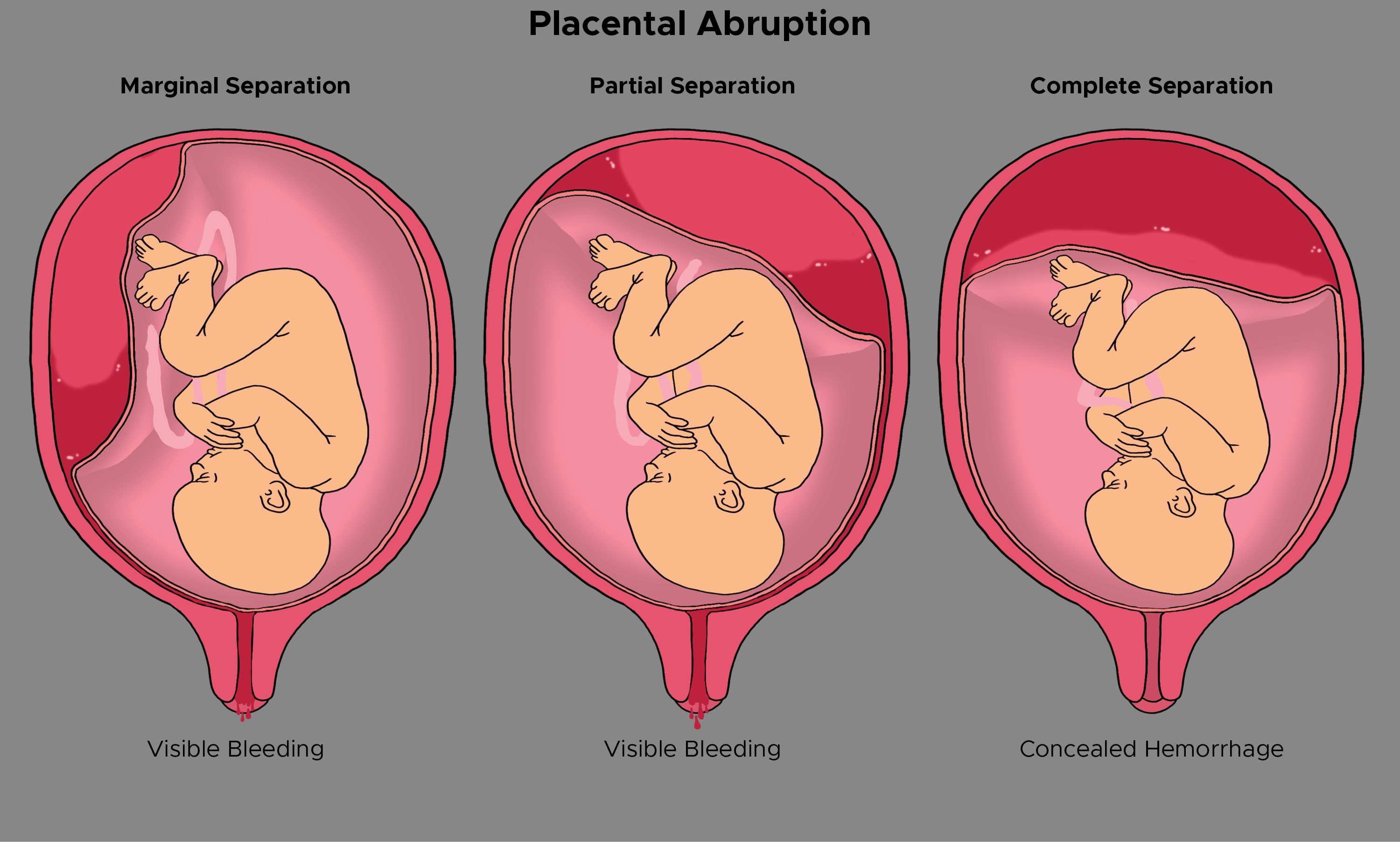 <p>Placental Abruption