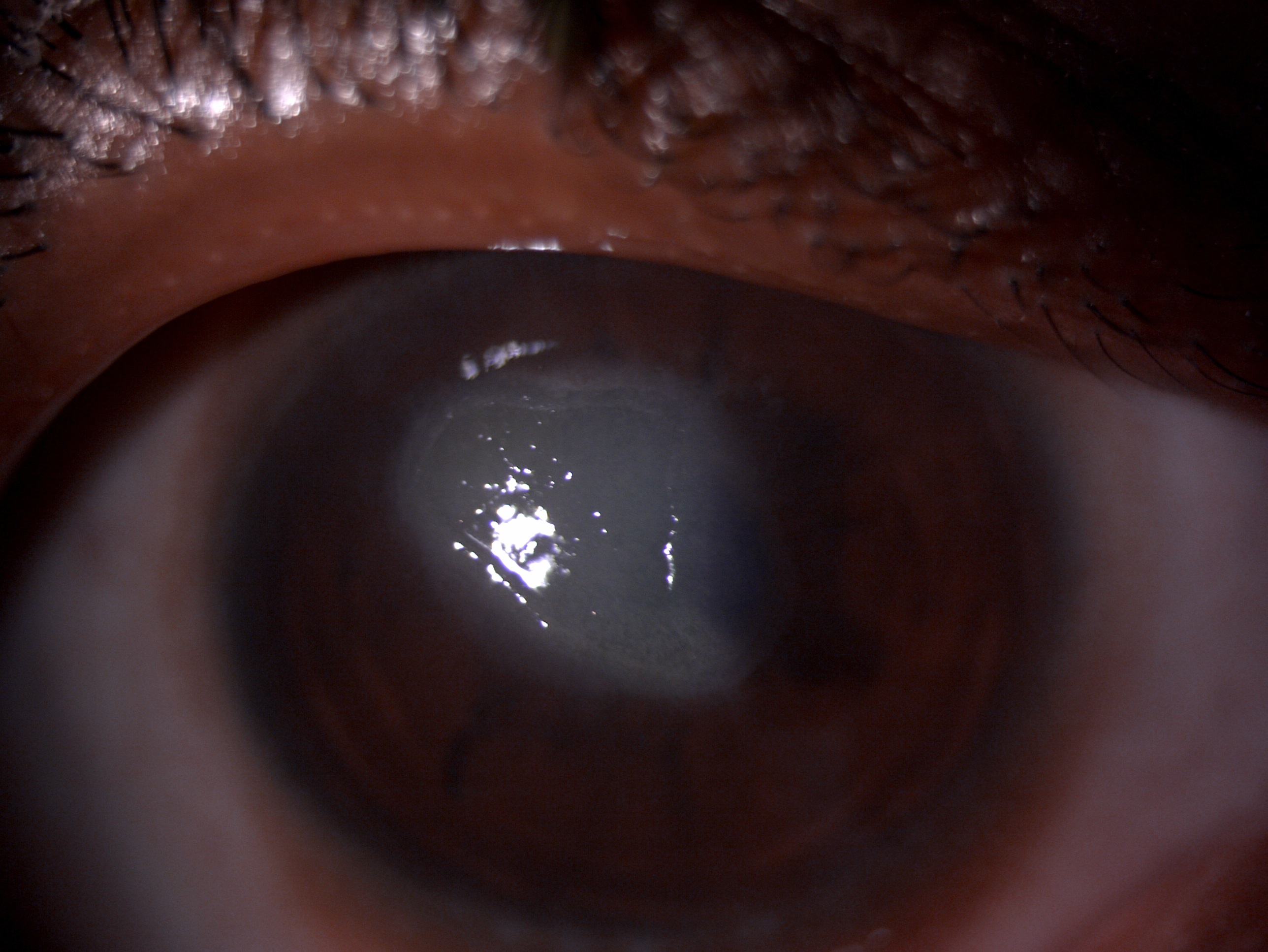 Slit lamp image of the patient depicting central corneal shield ulcer