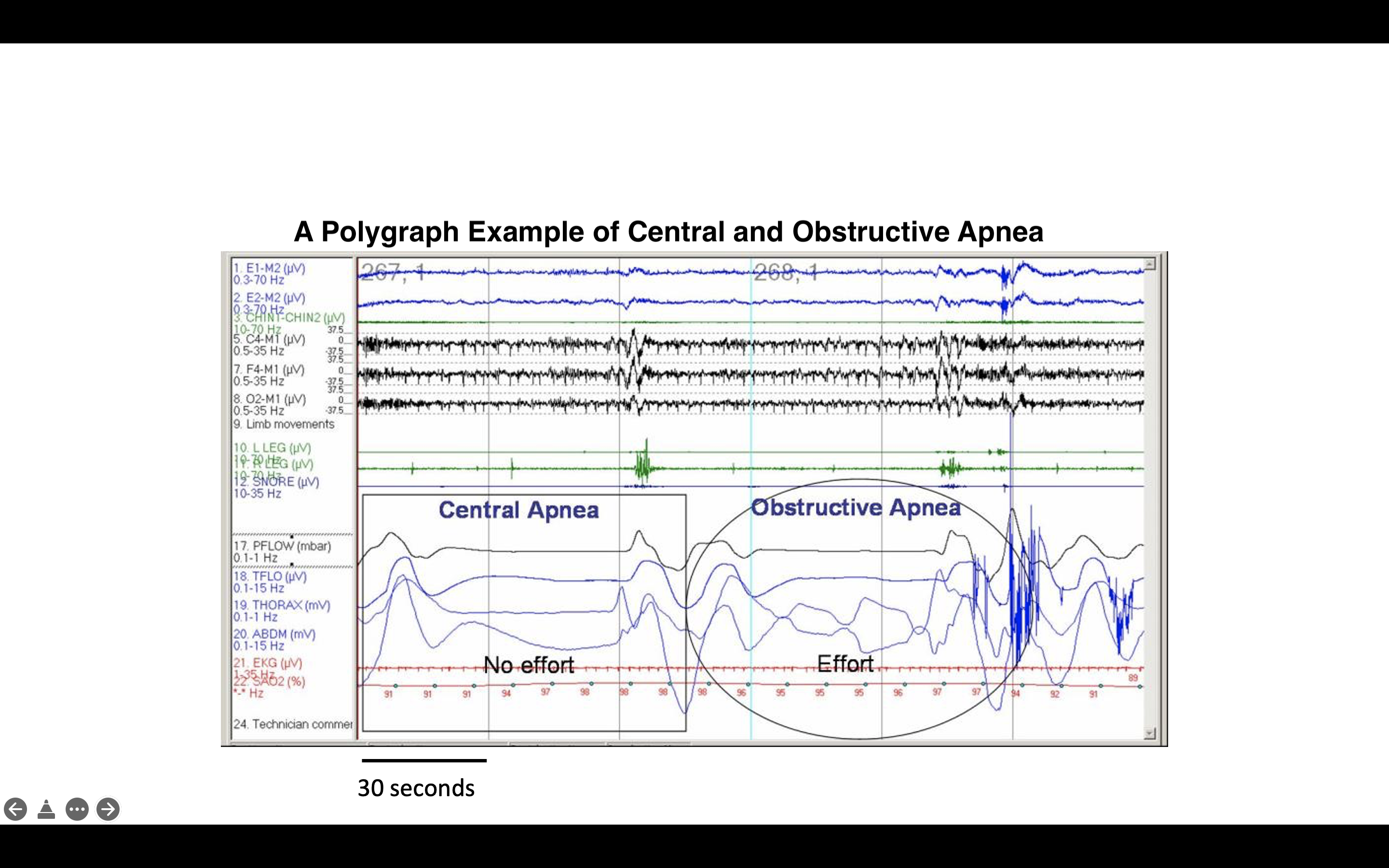 <p>Central and Obstructive Apnea, Polygraph. The image depicts an example of central and obstructive apnea.</p>