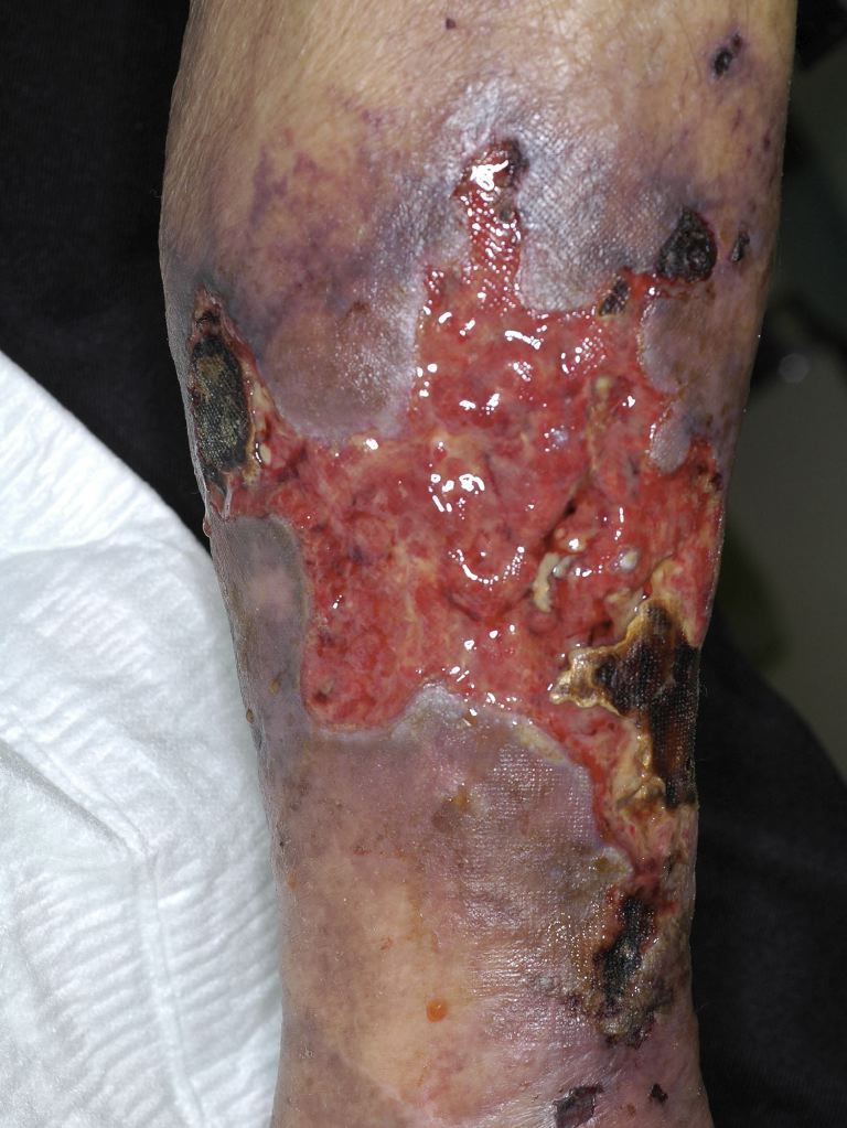 <p>Calciphylaxis</p>