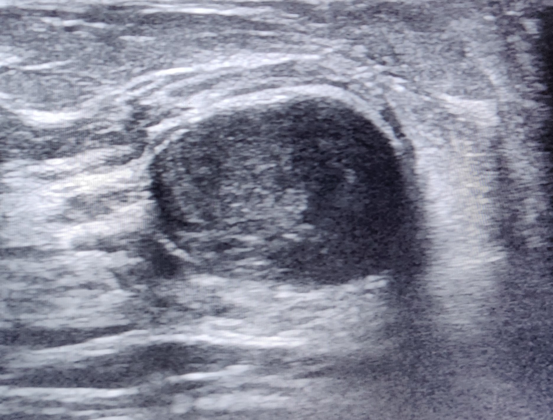 <p>Inspissated Galactocele. Ultrasound image showing round echoic cyst suggestive of inspissated galactocele.</p>