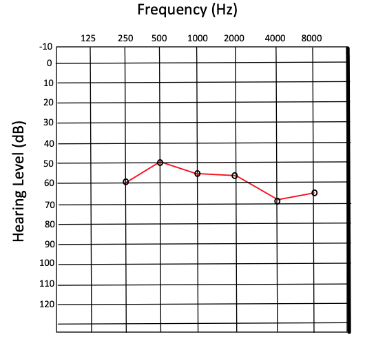 <p>Audiogram Results Showing Severe Hearing Loss.</p>