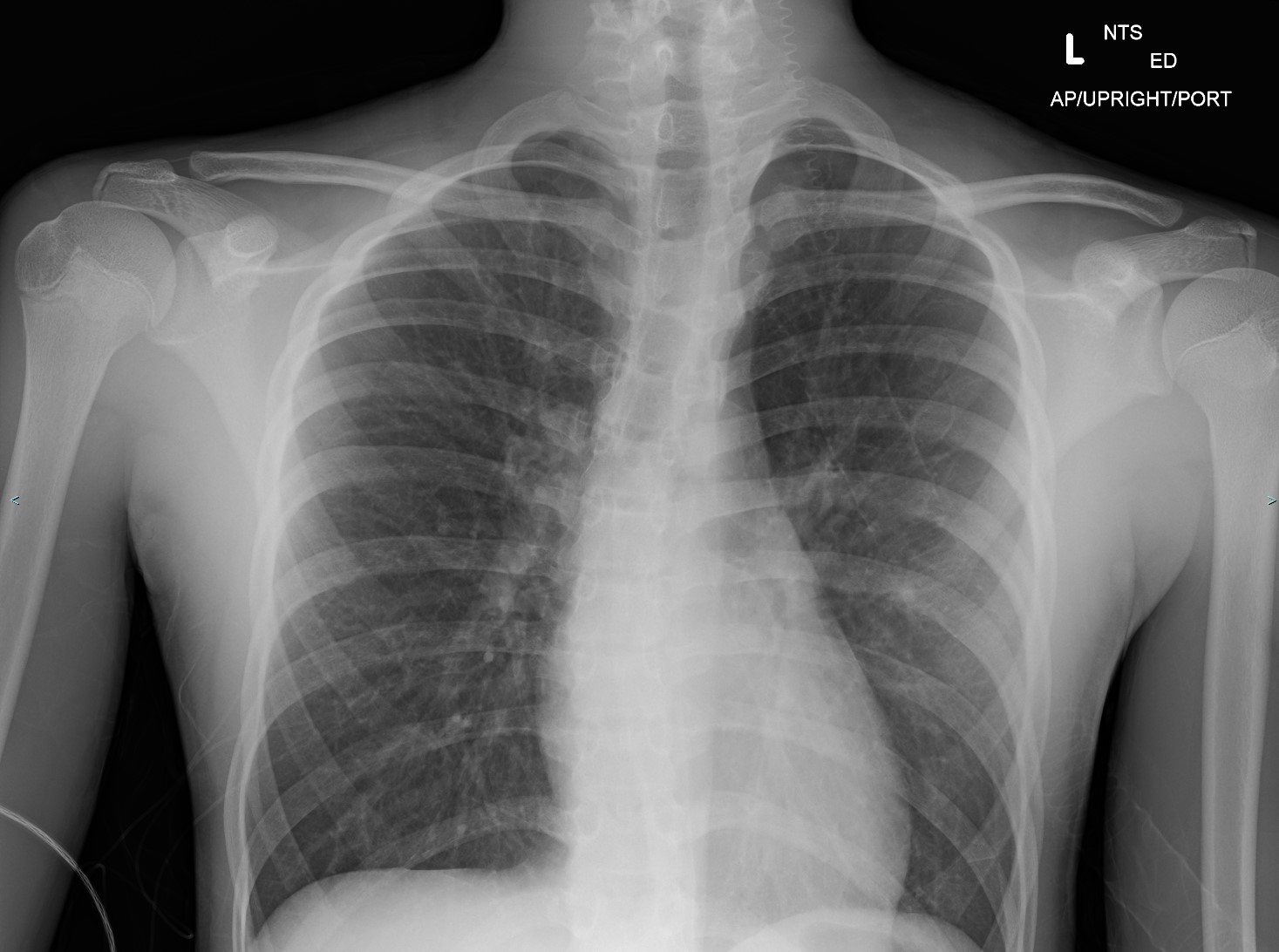 <p>Asthma Radiography