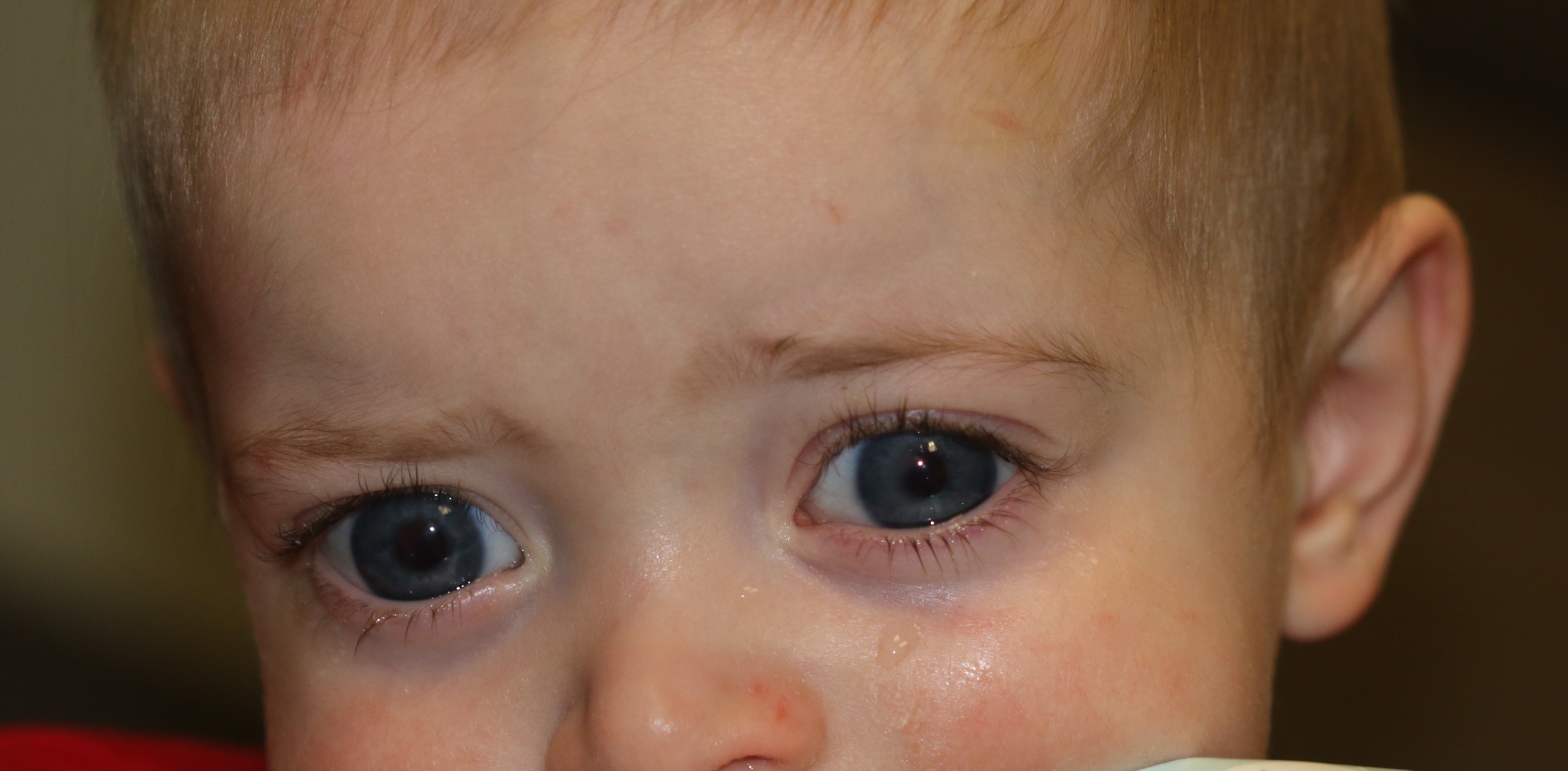 Buphthalmos in a 9-month-old male who presents with bilateral tearing and light sensitivity