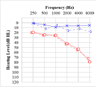 Audiogram, Vestibular Schwannoma