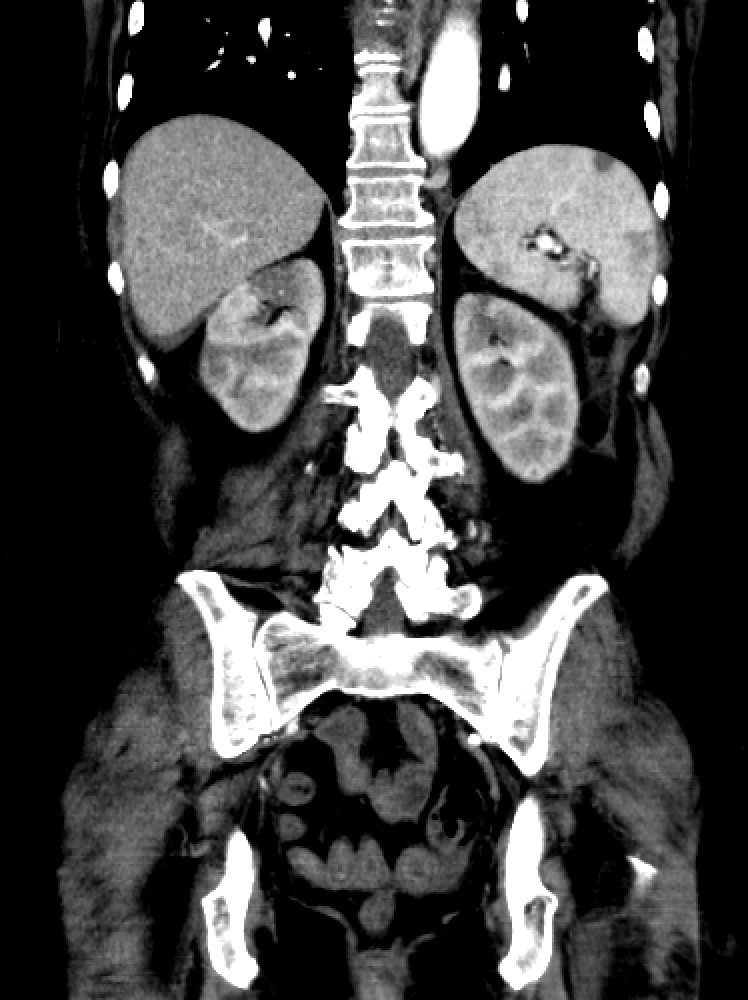 <p>Renal Infarction. CT imaging&nbsp;of a patient with renal infarction.</p>