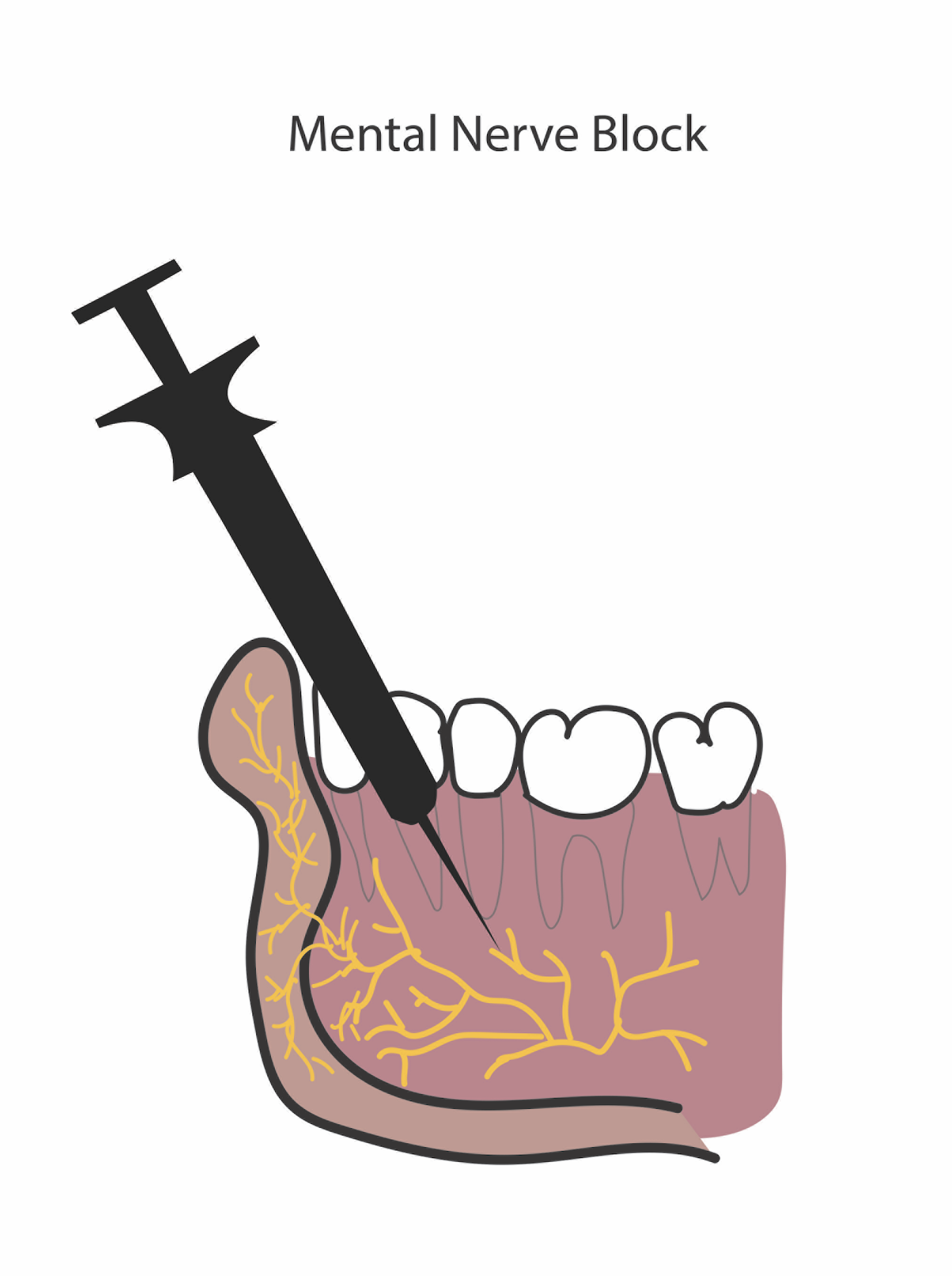 <p>Administration of a Mental Nerve Block. This is a diagram showing the administration of a mental nerve block.</p>
