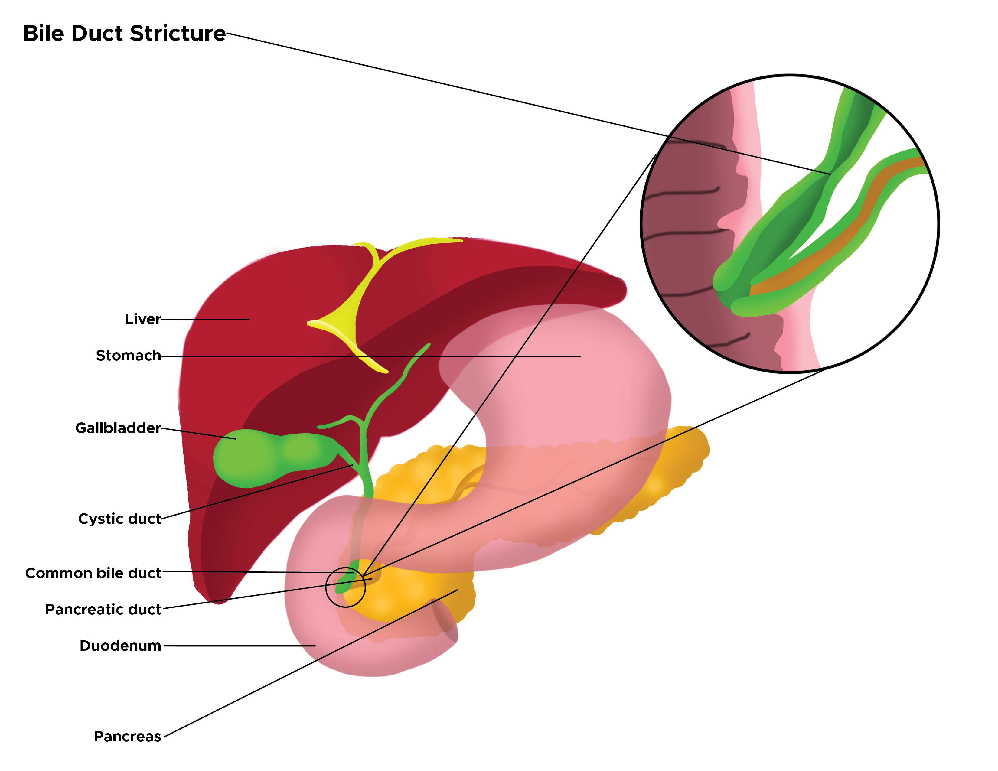 Illustration of bile duct stricture