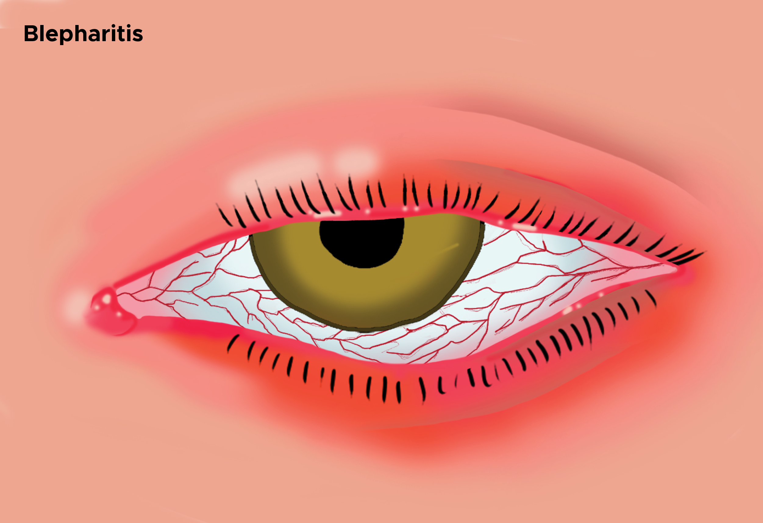 Illustration of blepharitis. Swollen eye.
