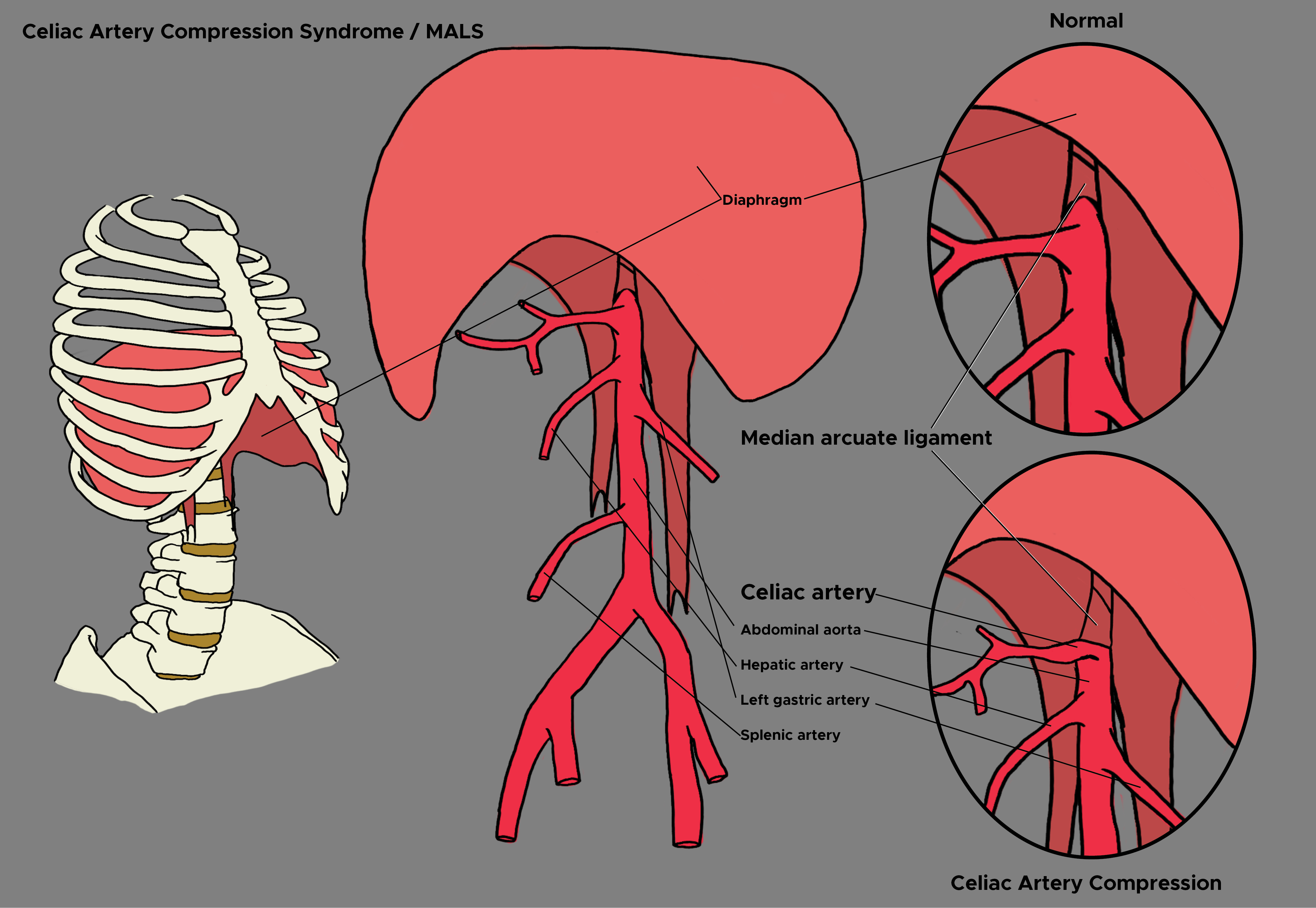 Illustration of Celiac Artery Compression Syndrome / MALS