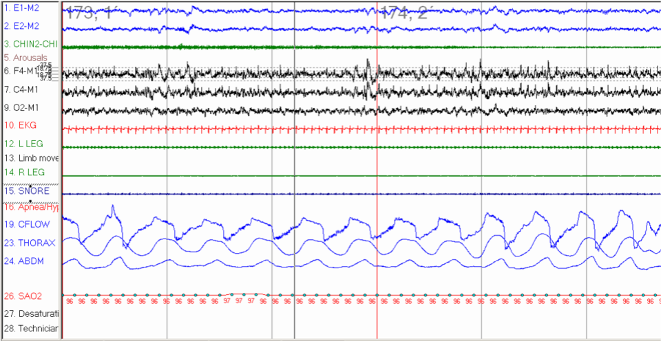 A polygraph from in-laboratory polysomnography (PSG) showing during N2 sleep period of inspiratory flow limitation (flattening of inspiratory phase on flow signal) without associated desaturation or definitive hypopnea
