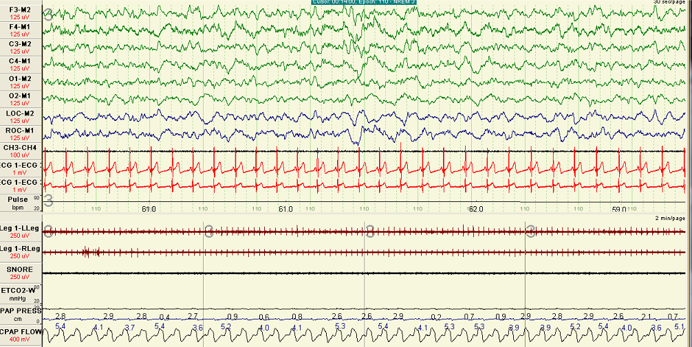 A polygraph during NREM sleep after optimal CPAP titration is achieved