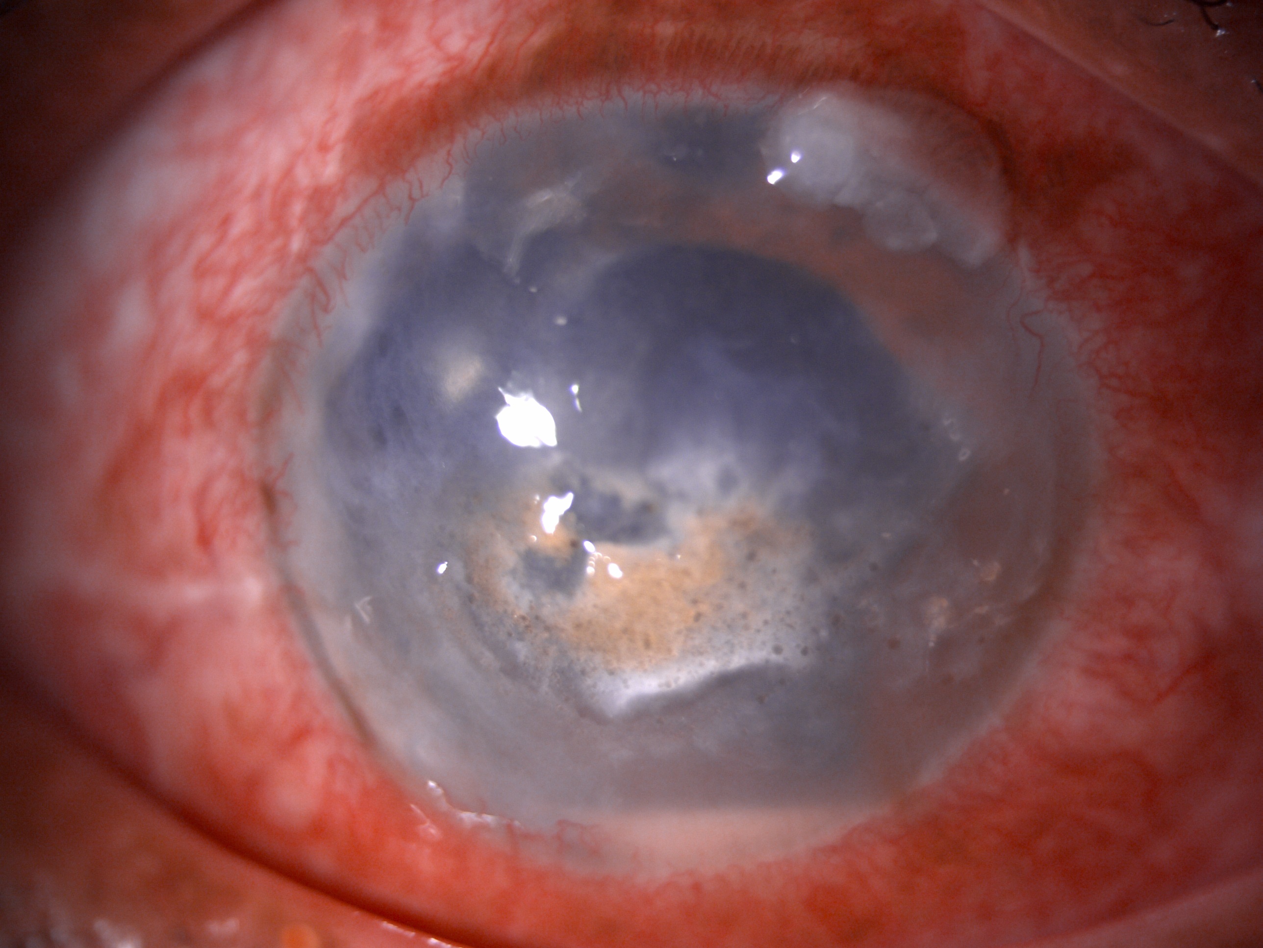 Slit-lamp image of the patient of recurrent anterior uveitis depicting circumciliary congestion, corneal scarring, central ba