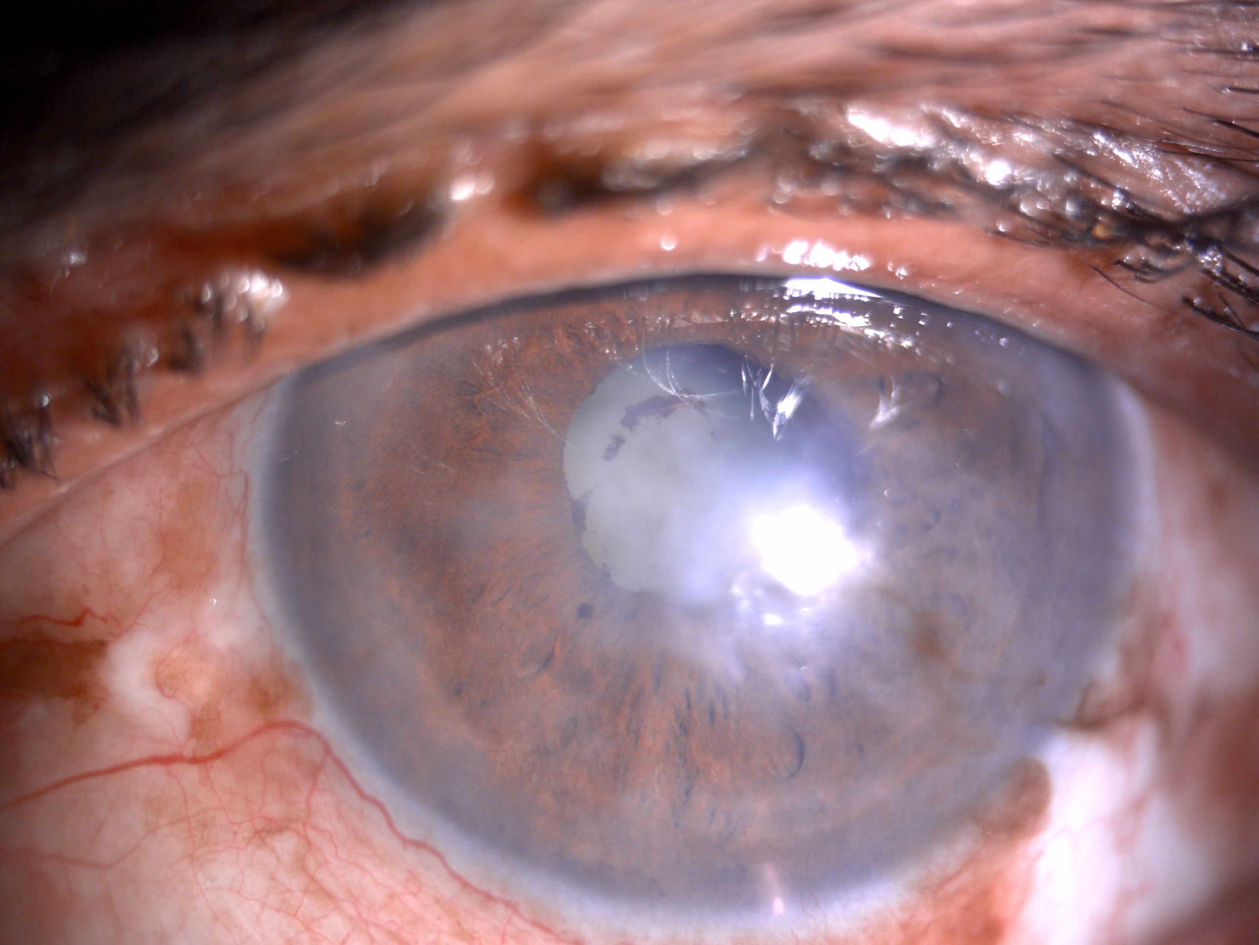 Slit- lamp image of the patient with recurrent uveitis depicting mild circumciliary congestion, nebular corneal scarring, few
