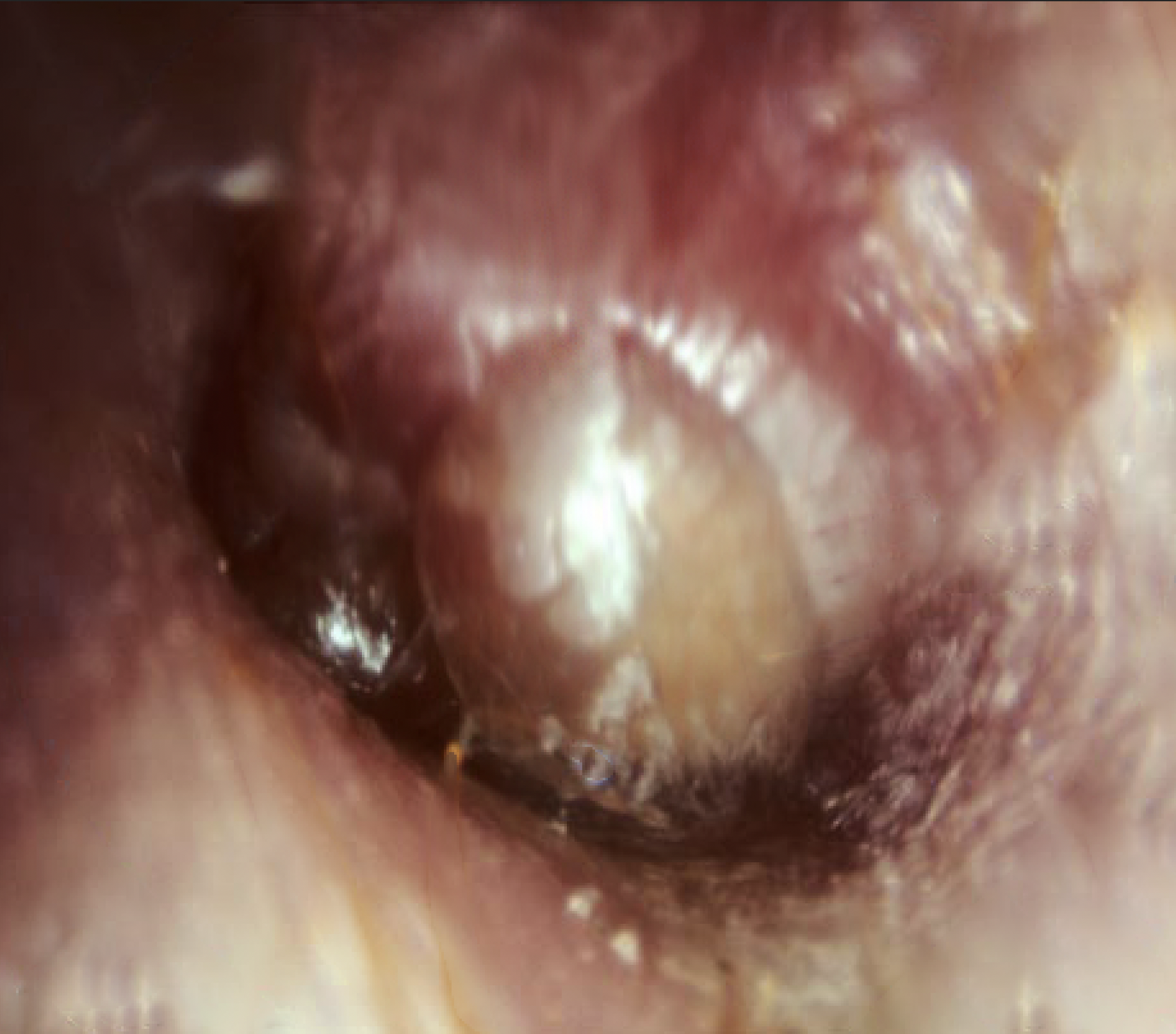 Example of bullous myringitis.
