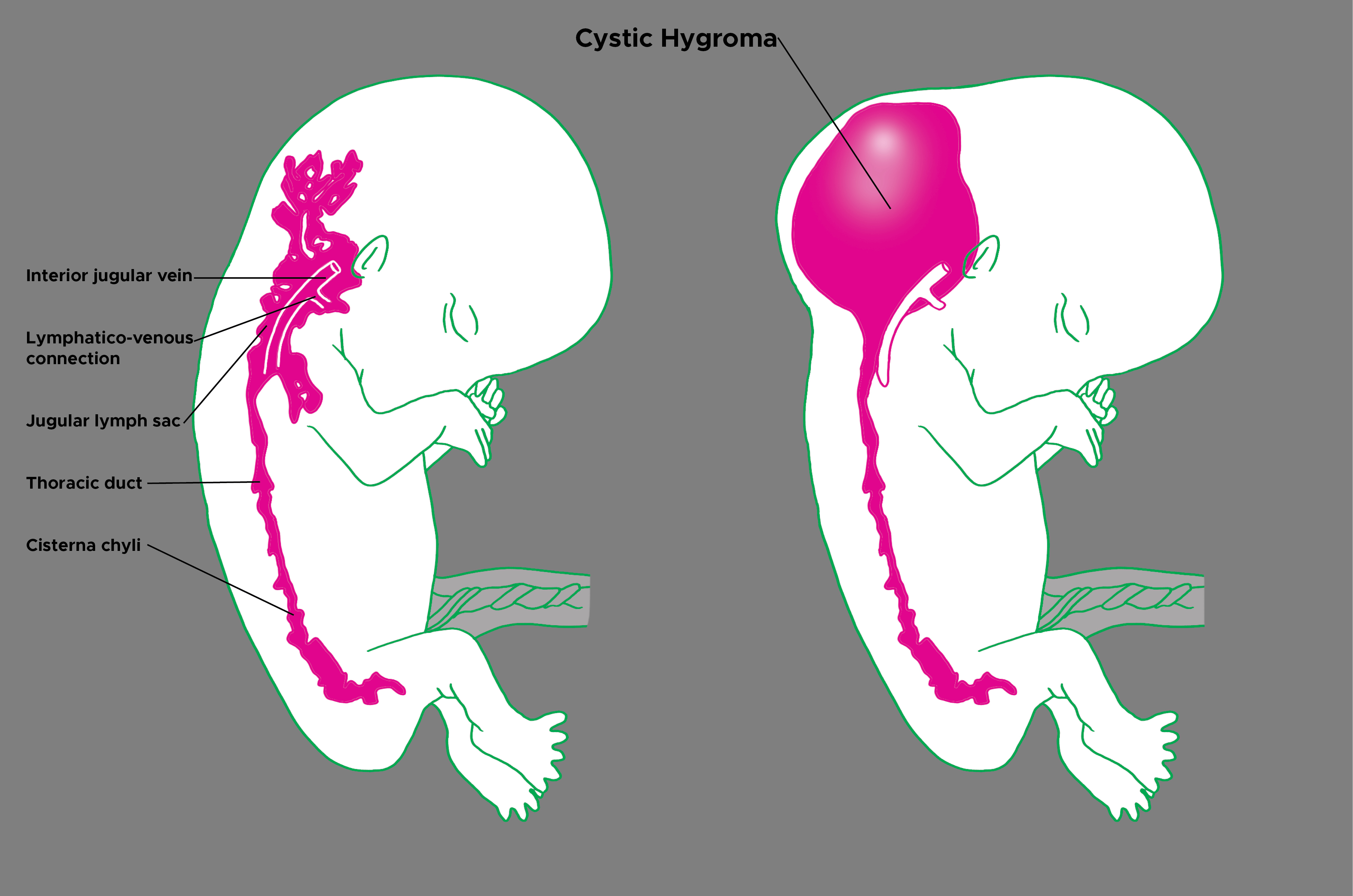 Illustration of normal fetus and fetus with cystic hygroma.