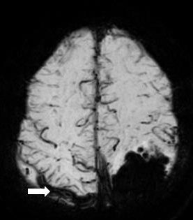 <p>Cortical Vein Thrombosis