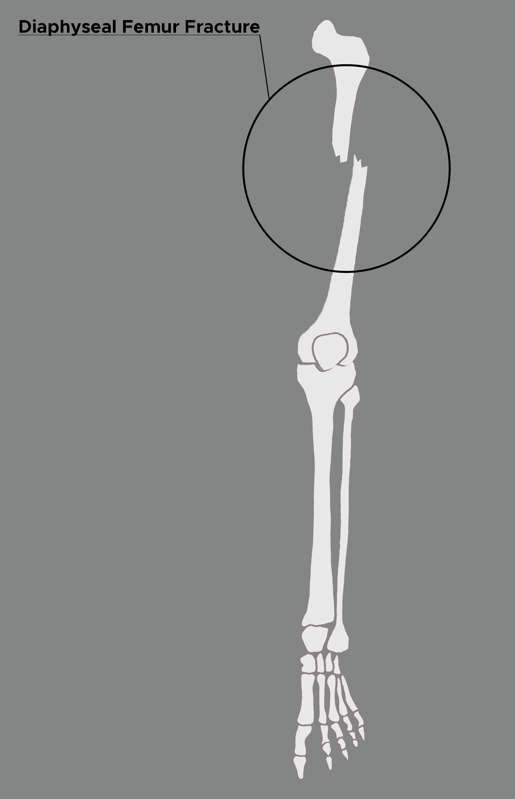 <p>Diaphyseal Femur Fracture. This illustration&nbsp;depicts&nbsp;a femur with a diaphyseal fracture.</p>