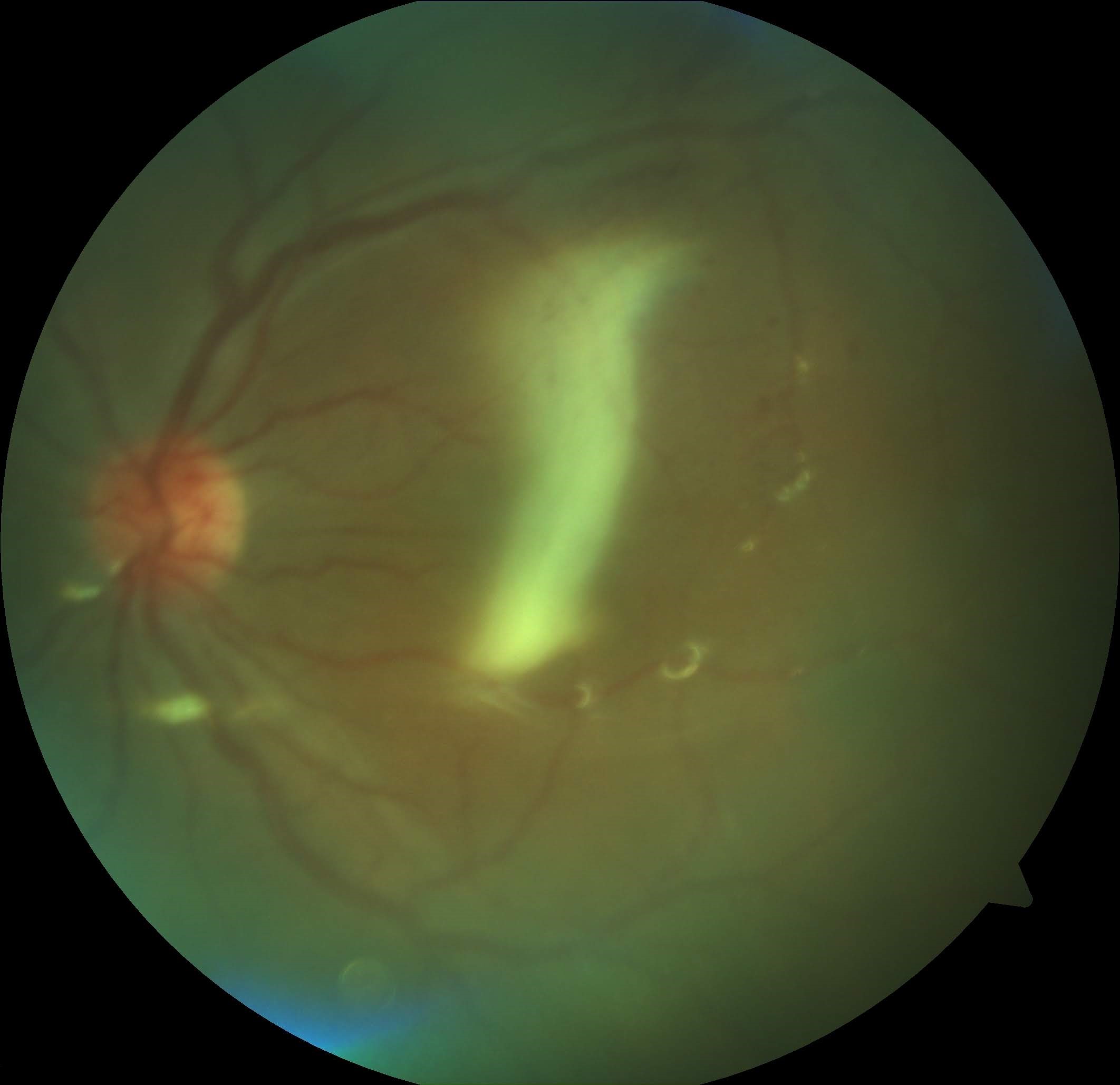 Color fundus photo of a silicone oil-filled eye (note the shiny reflex)