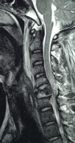 <p>Cord Compression Following Cervical Spine Injury</p>