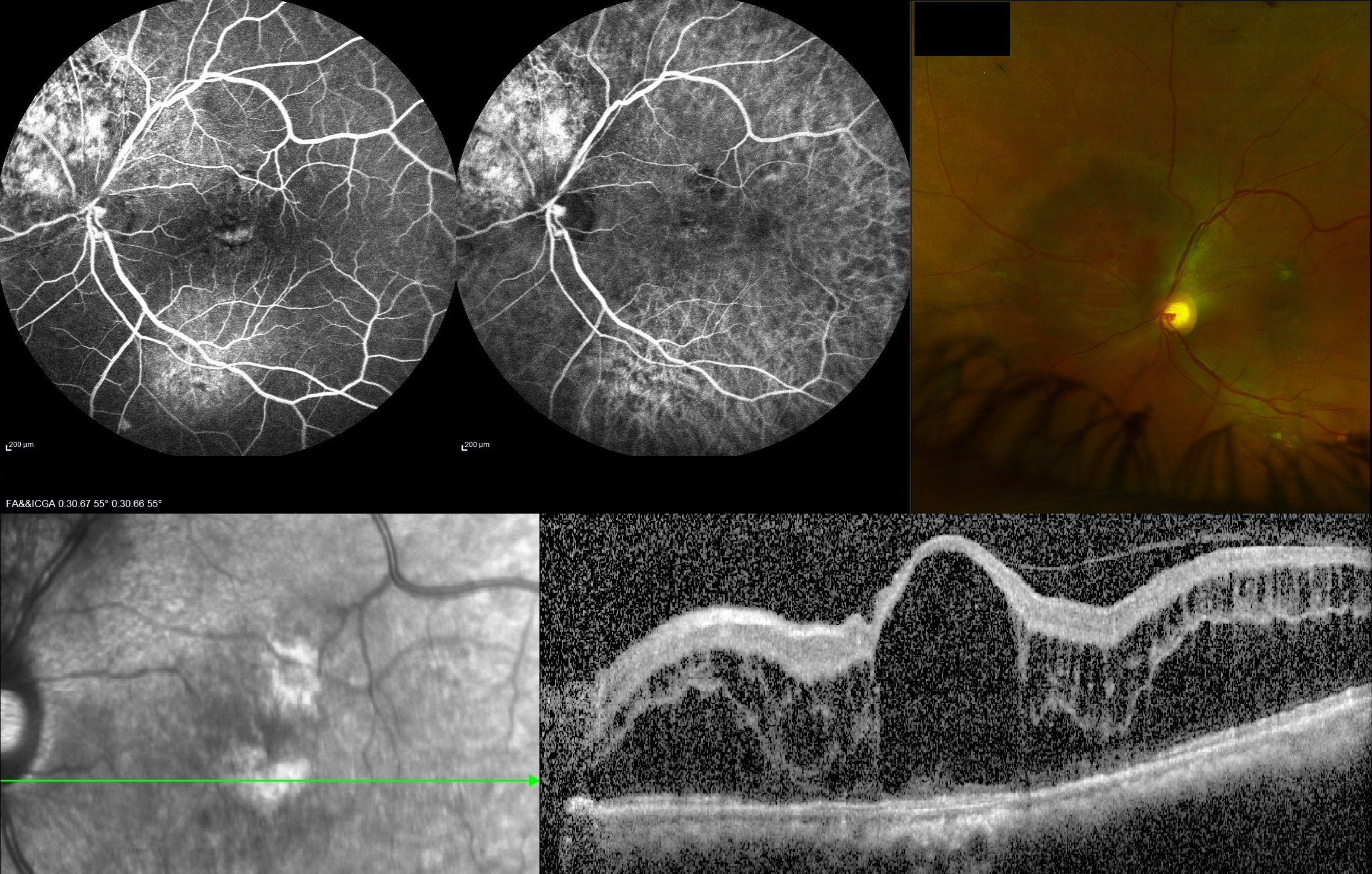 FA (A), ICGA (B), color fundus photo (C) and optical coherence tomography image (D) of the left eye of a patient with circums