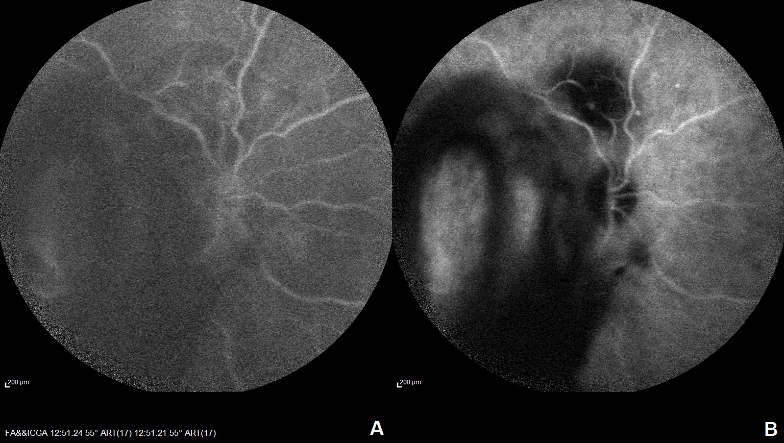 FA (A) and ICGA (B) of the right eye of a patient with RAM at superotemporal arcade with vitreous hemorrhage