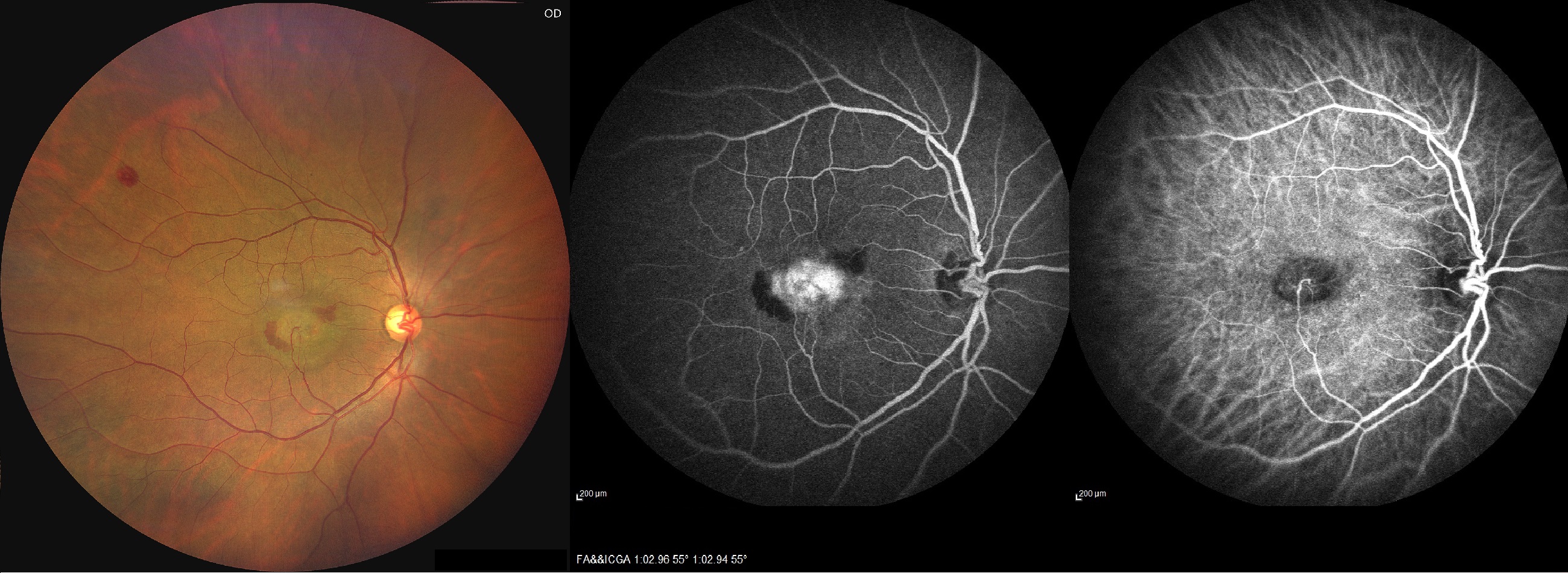 Color fundus photo (A), FA (B) and ICGA (C) of the right eye of a patient with RAP