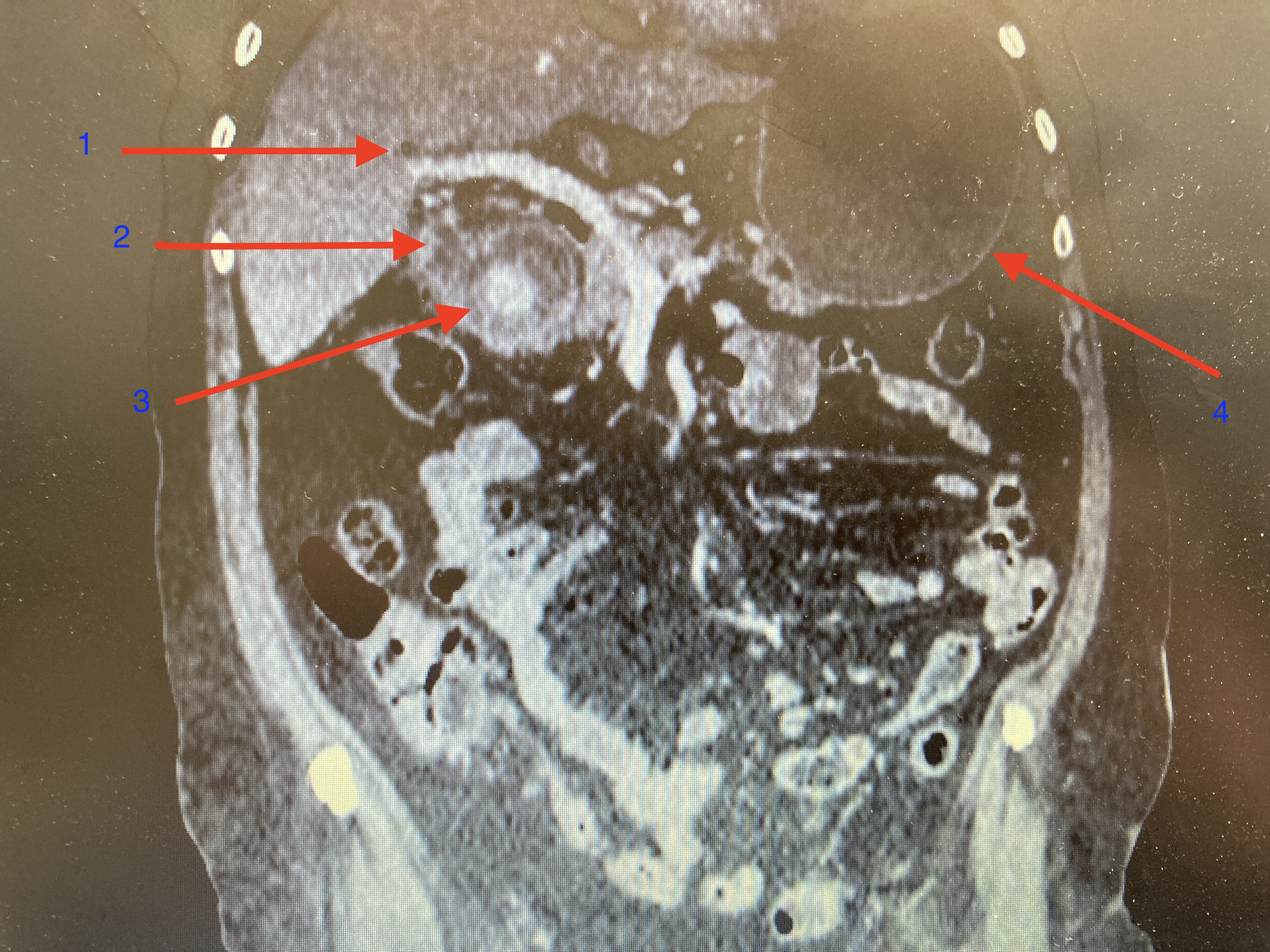 Initial computed tomography of the abdomen revealed typical bouveret syndrome with Rigler triad