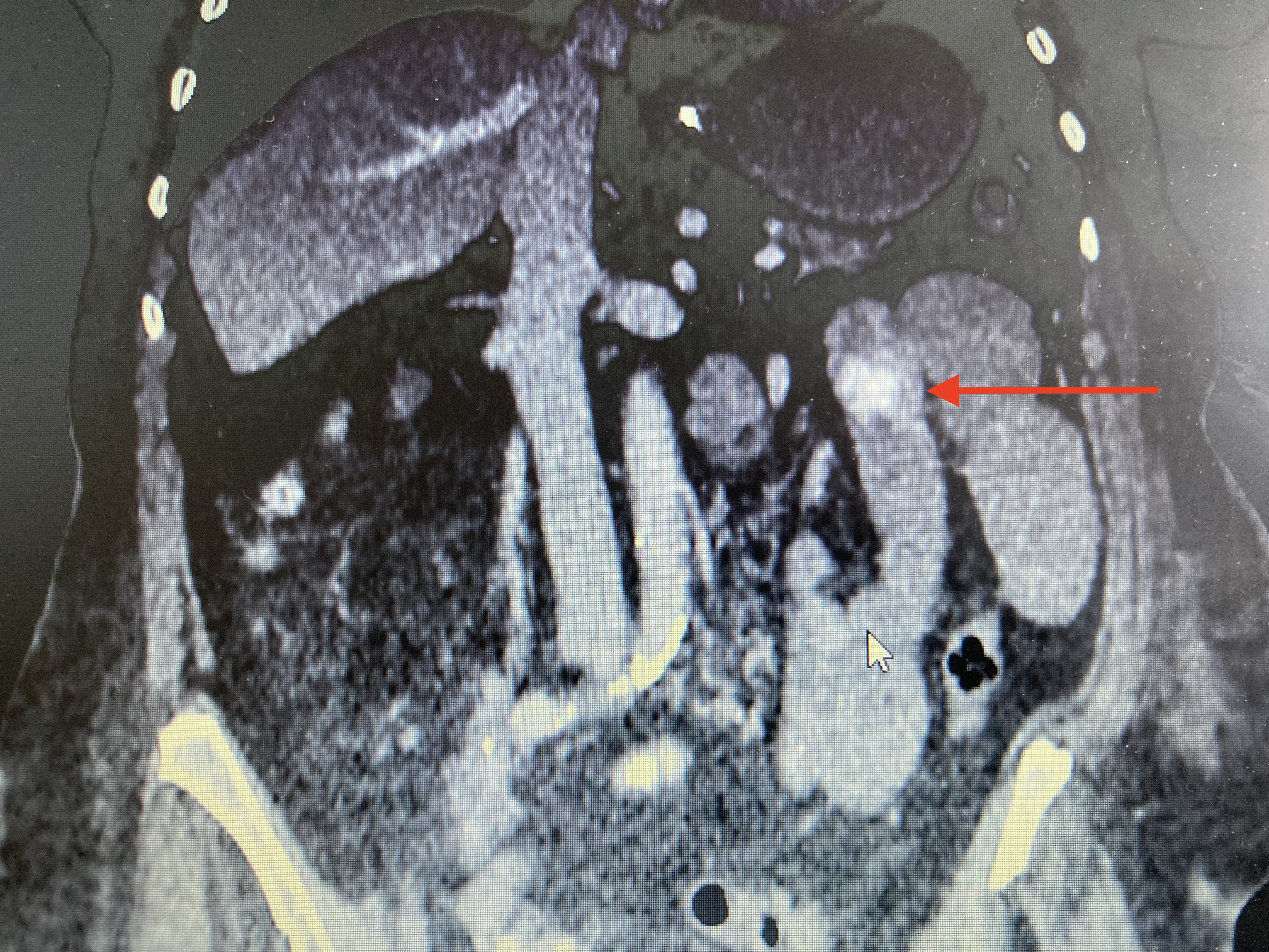 Computed tomography of the abdomen showing a migrated gallstone after endoscopic lithotripsy, causing gallstone ileus in the proximal jejunum